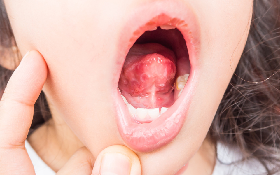 腸病毒會使兒童口腔內出現水泡