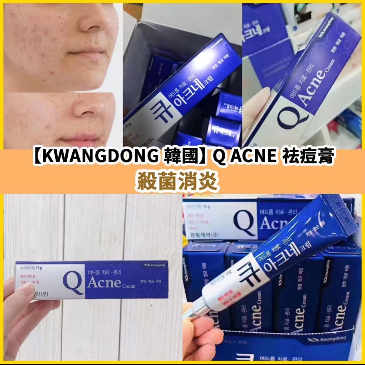 【直播】LL121621 Q Acne 祛痘膏 15g