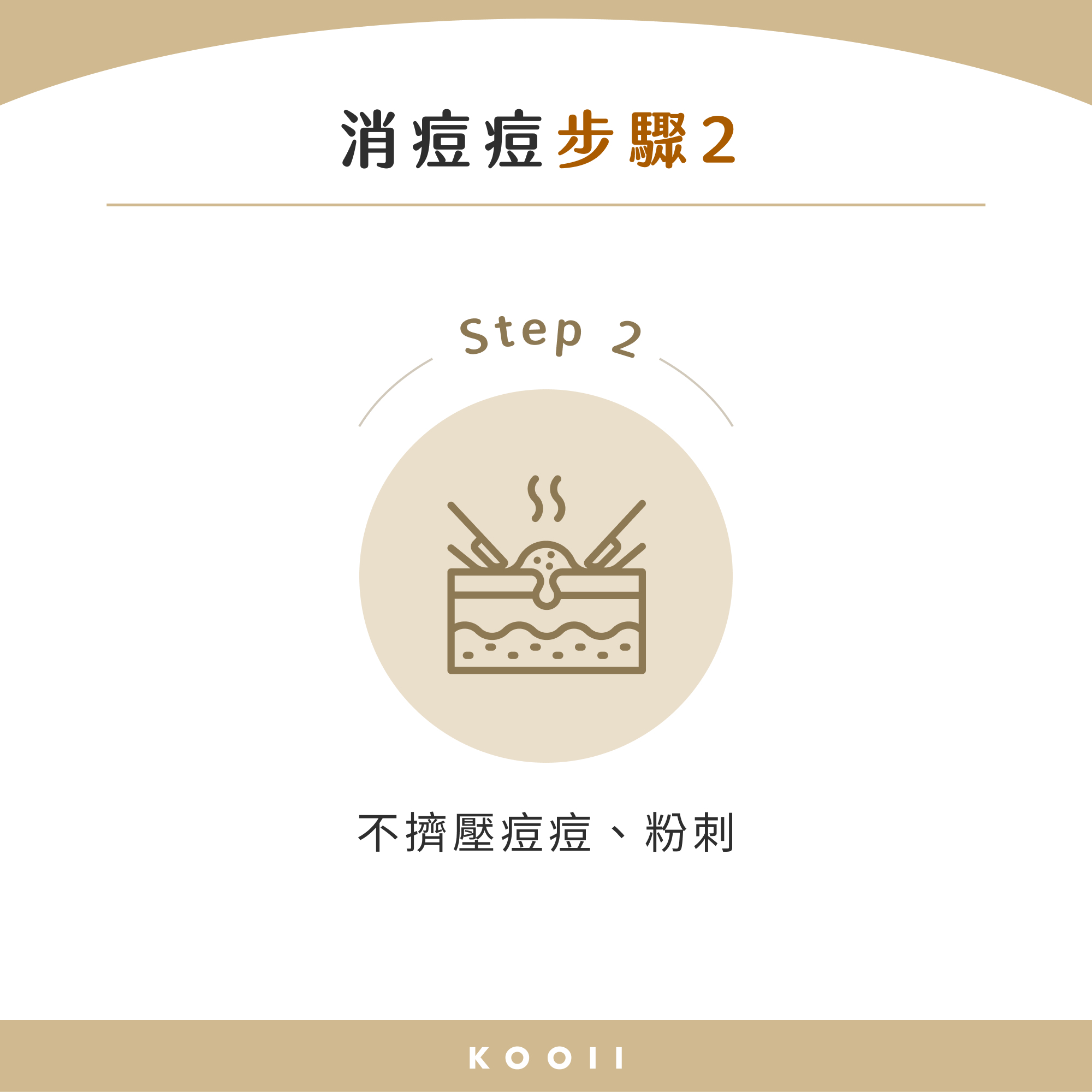 消痘痘步驟 2：不擠壓痘痘、粉刺