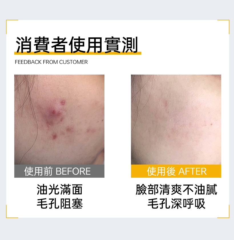 控油洗臉慕斯_抗痘洗面乳