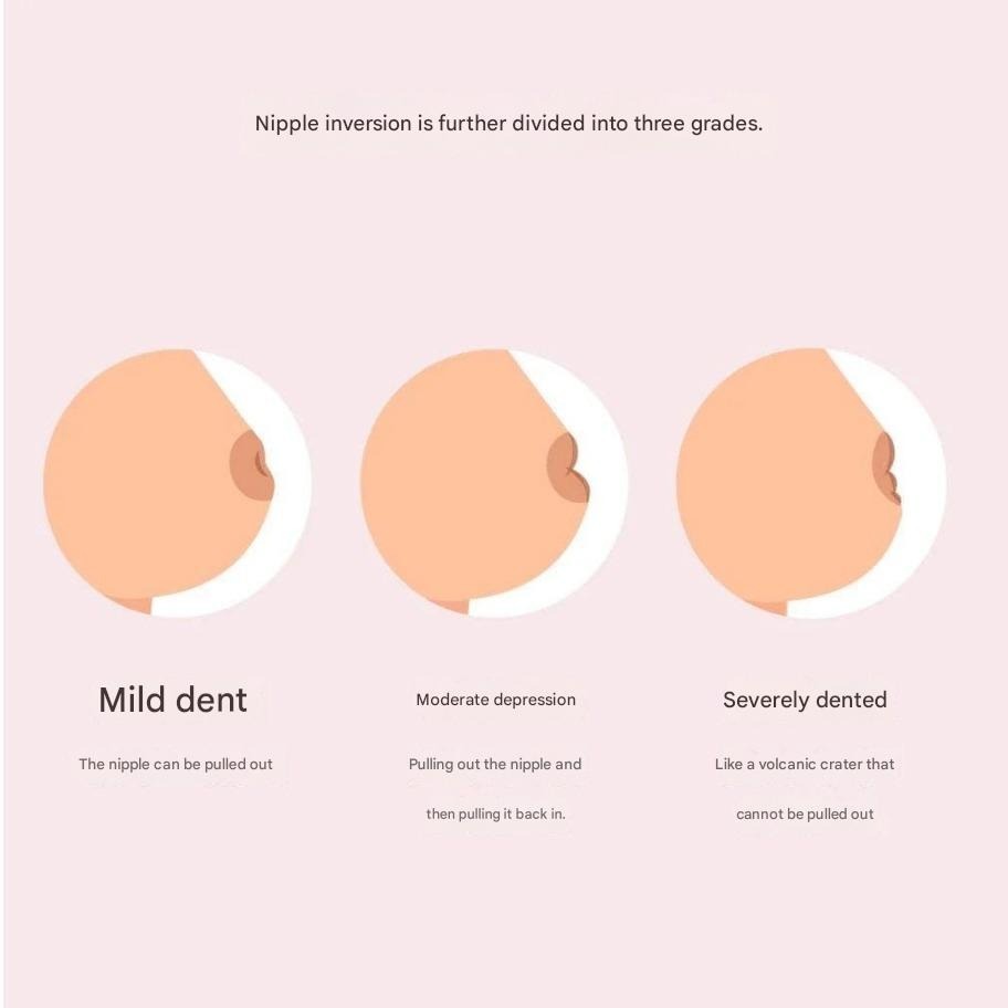 Illustration of inverted or flat areola type – common natural variation