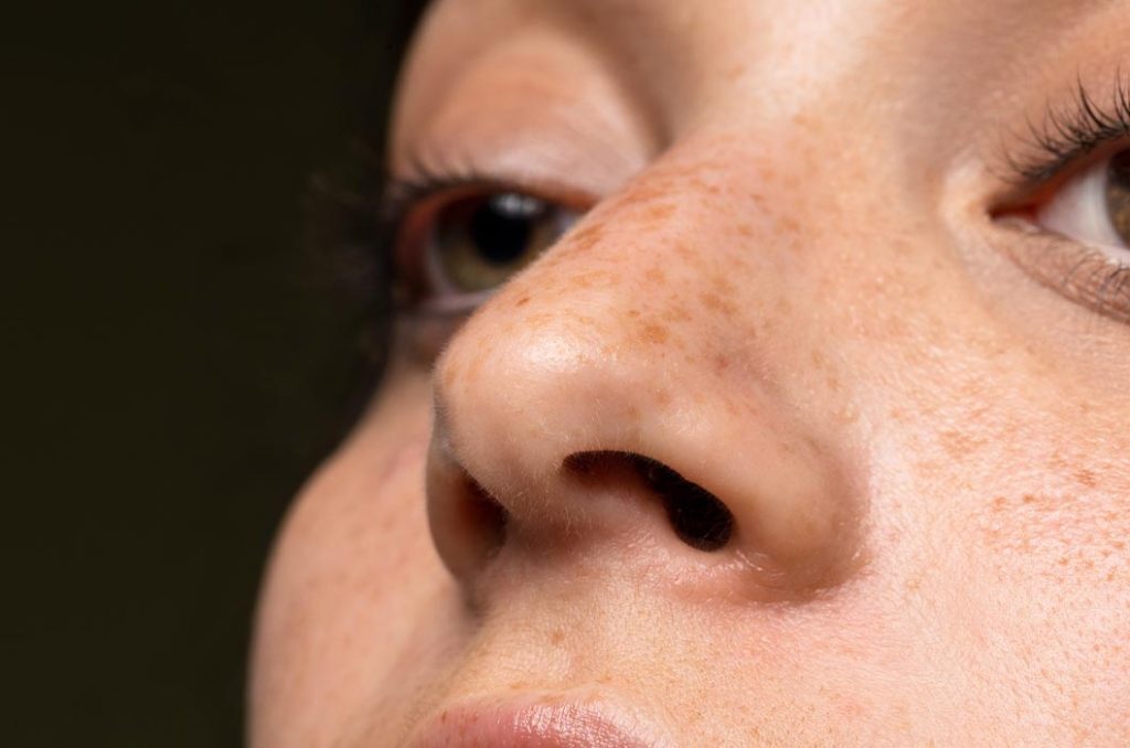 黑色素沉澱要擦什麼