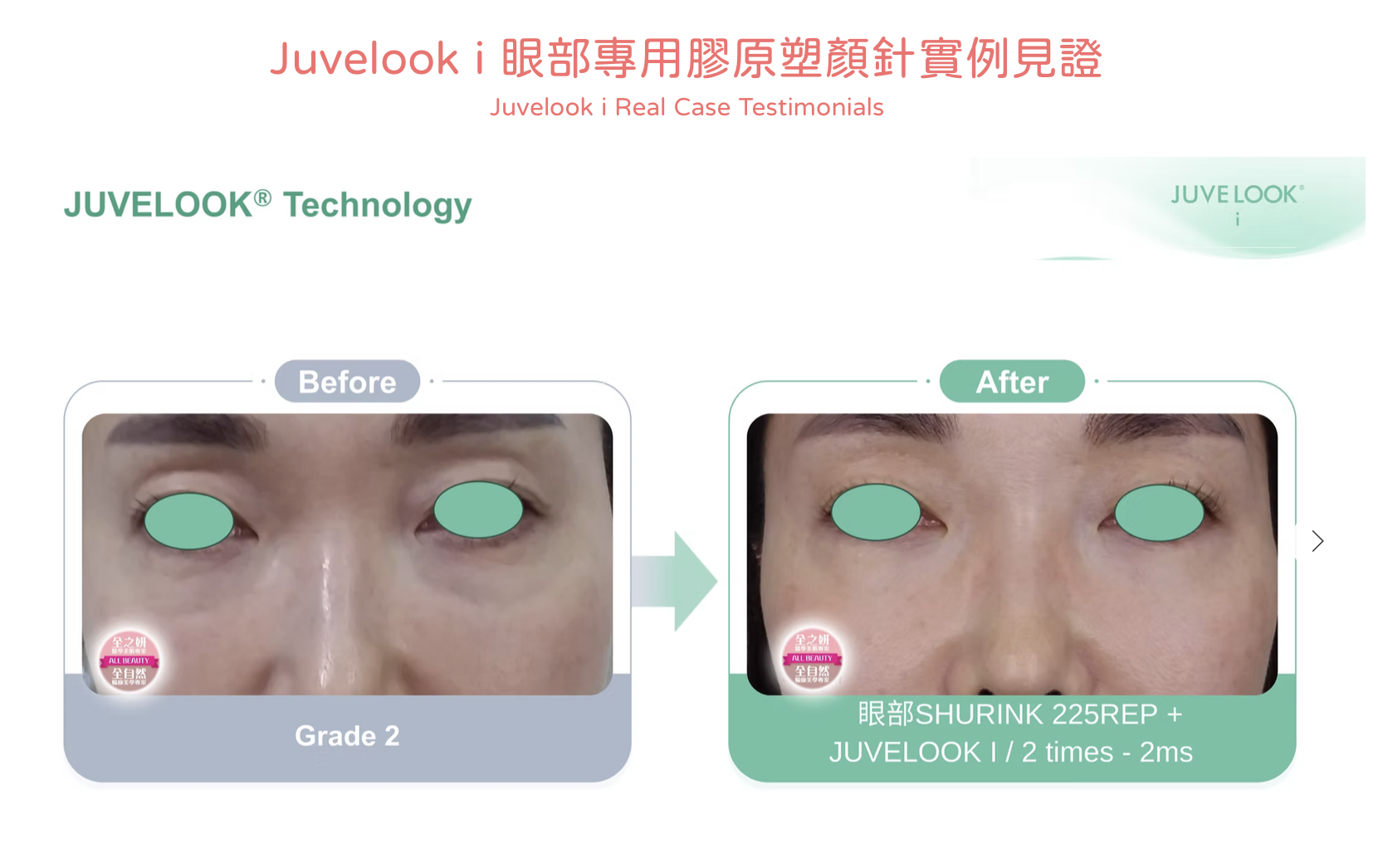 Juvelook I 眼部素顏針 香港 醫美診所