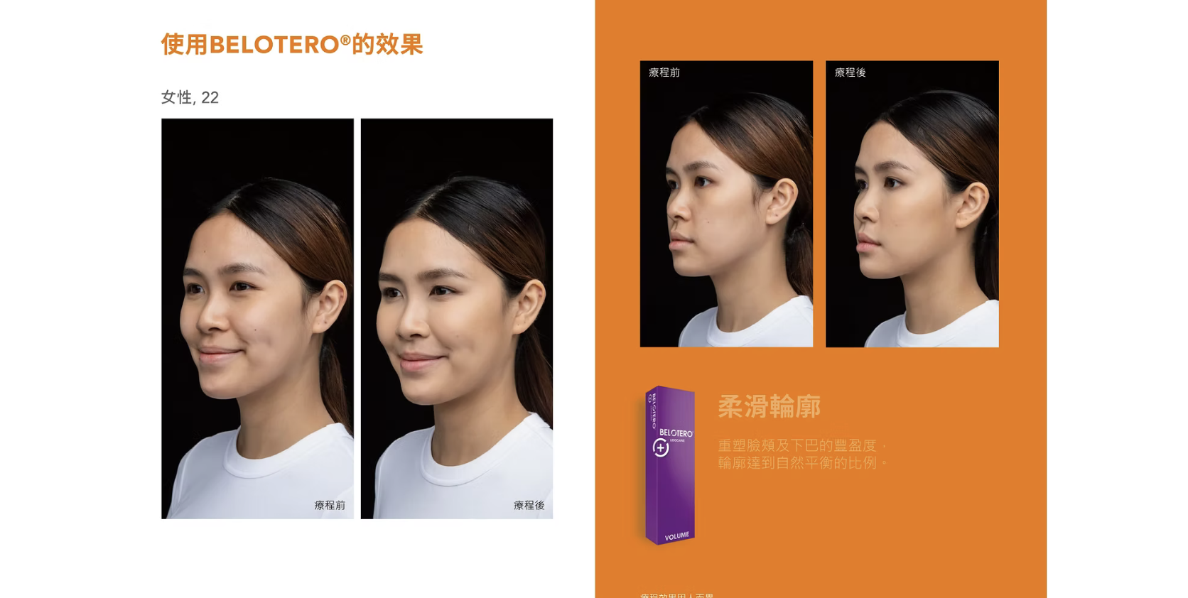 Belotero 彩虹針 透明質酸填充 醫美診所