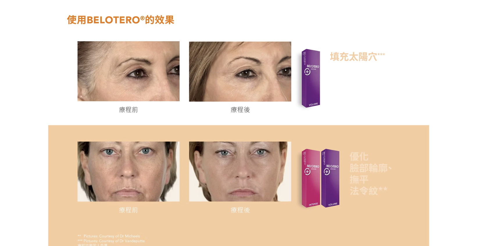 Belotero 彩虹針 透明質酸填充 醫美診所