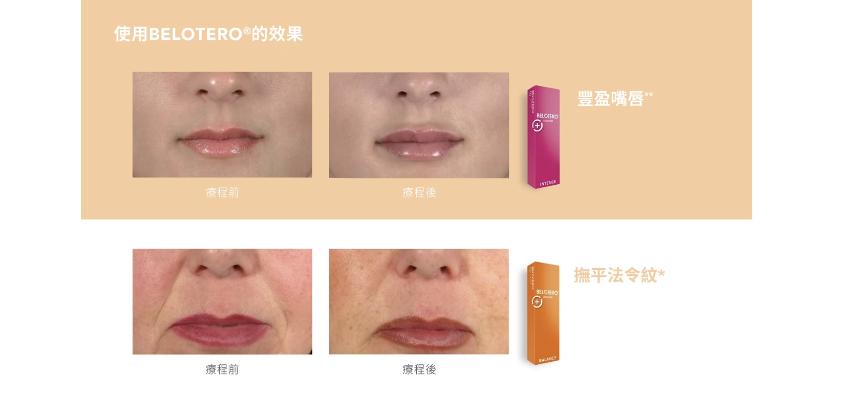 Belotero 彩虹針 透明質酸填充 醫美診所