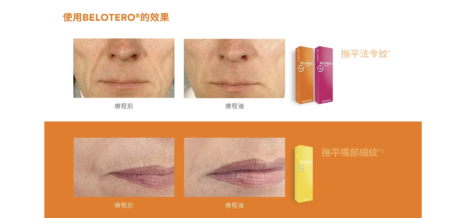 Belotero 彩虹針 透明質酸填充 醫美診所