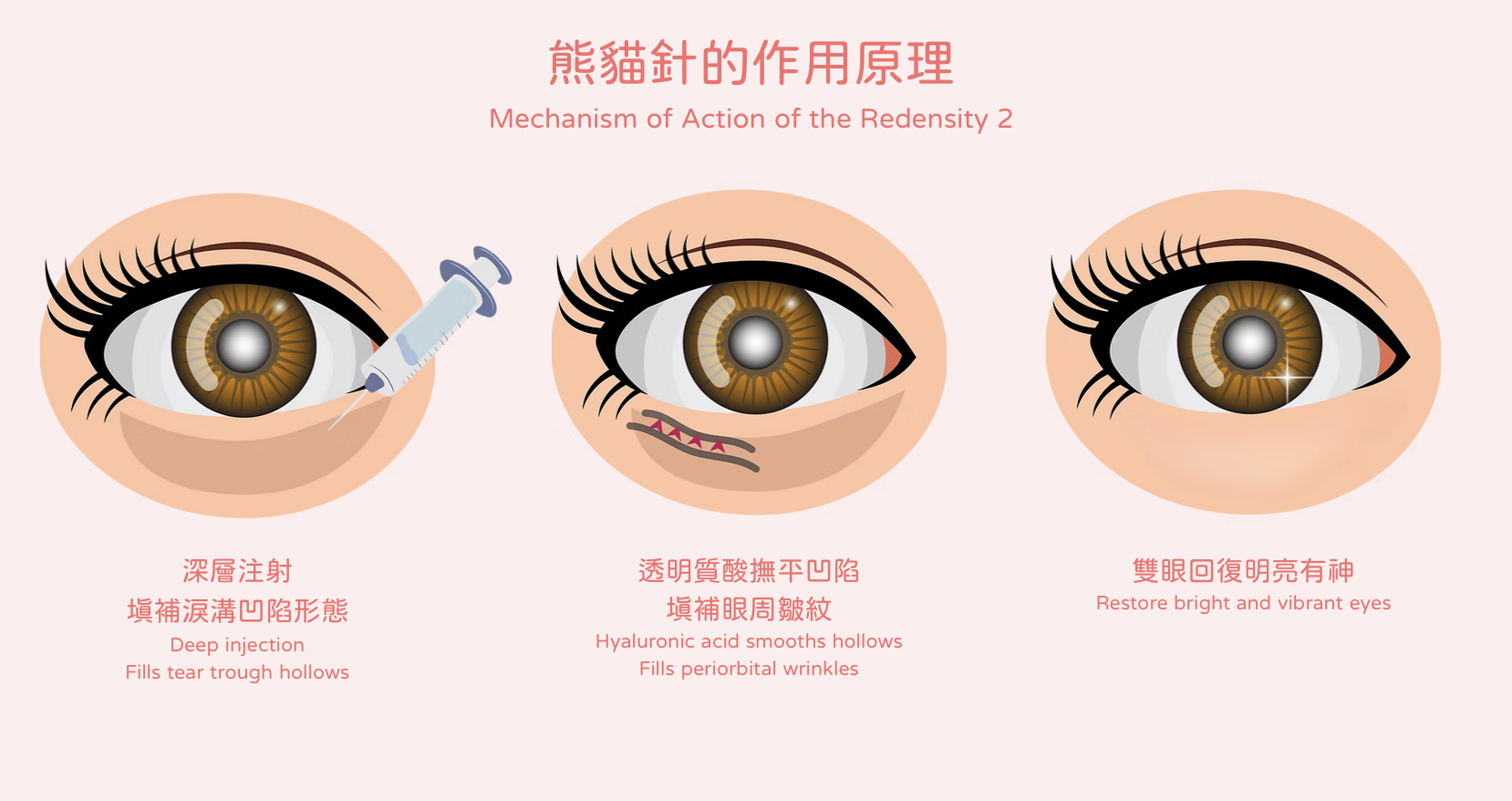 告別淚溝 黑眼圈 眼袋 Redensity 2 熊貓針 醫美診所