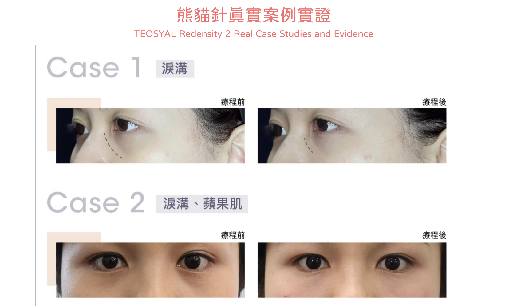 告別淚溝 黑眼圈 眼袋 Redensity 2 熊貓針 醫美診所