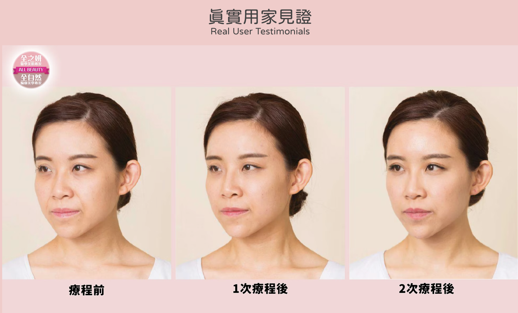 Restylane 瑞藍透明質酸填充 醫美診所 瑞蓝透明质酸填充 医美诊所