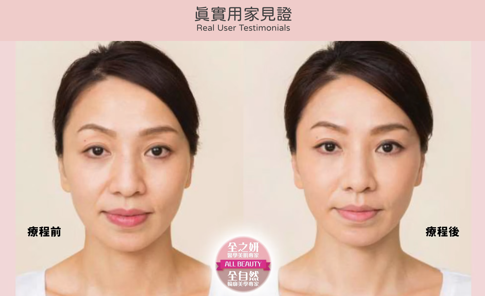 Restylane 瑞藍透明質酸填充 醫美診所 瑞蓝透明质酸填充 医美诊所