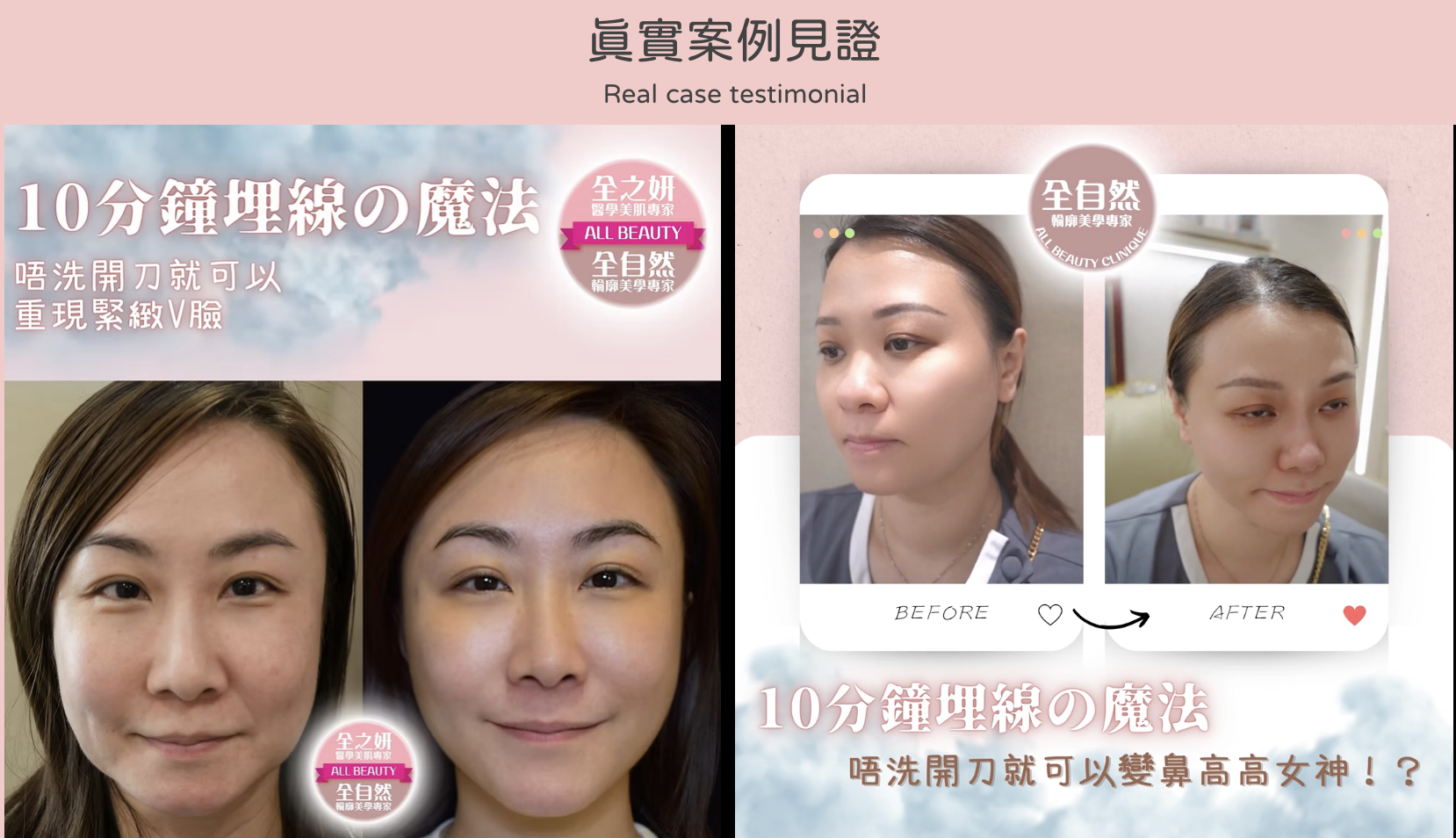 埋線提拉 醫美診所 埋线提拉 医美诊所