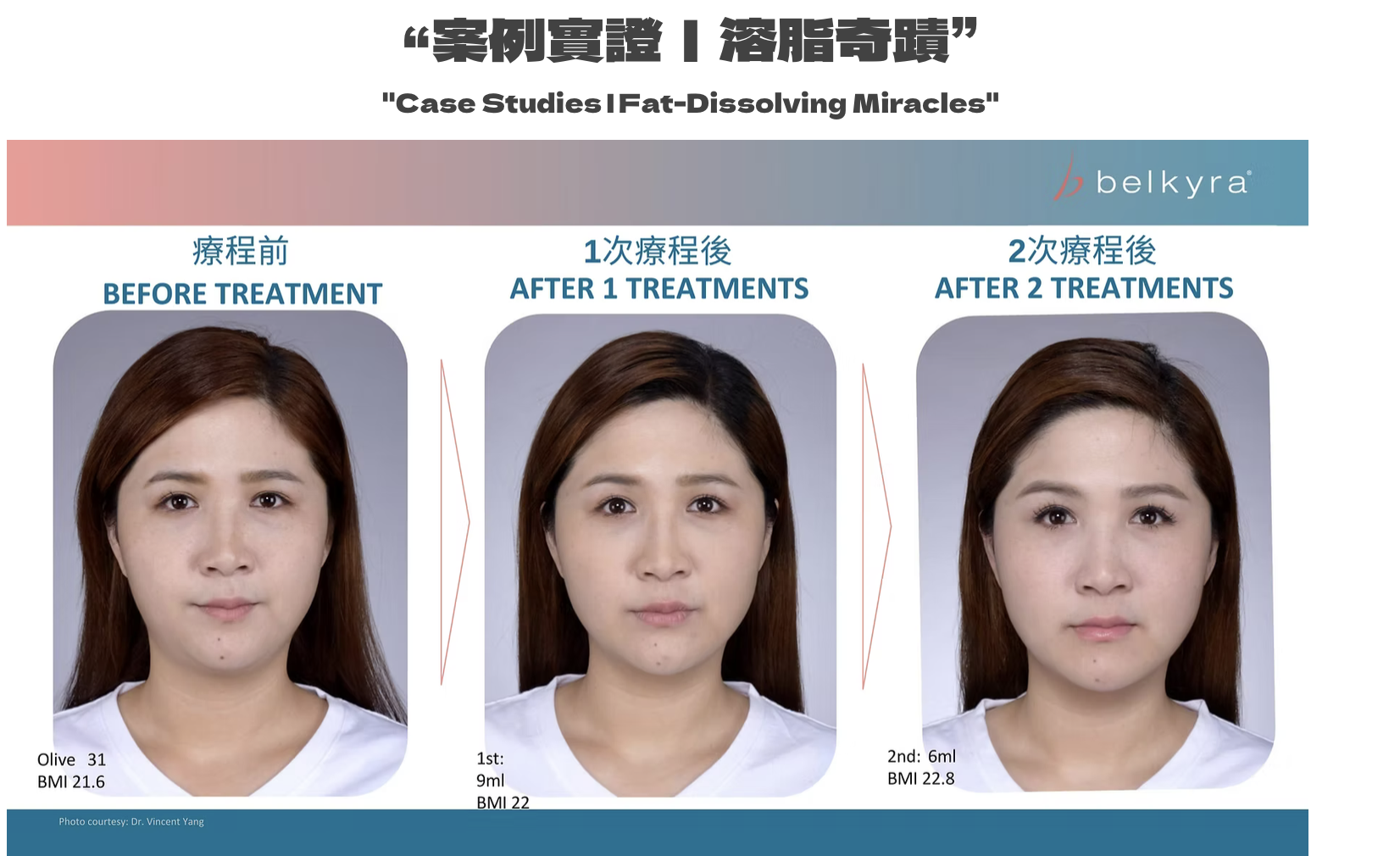 永久雙下巴溶脂Belkyra 醫美診所 永久双下巴溶脂 医美诊所