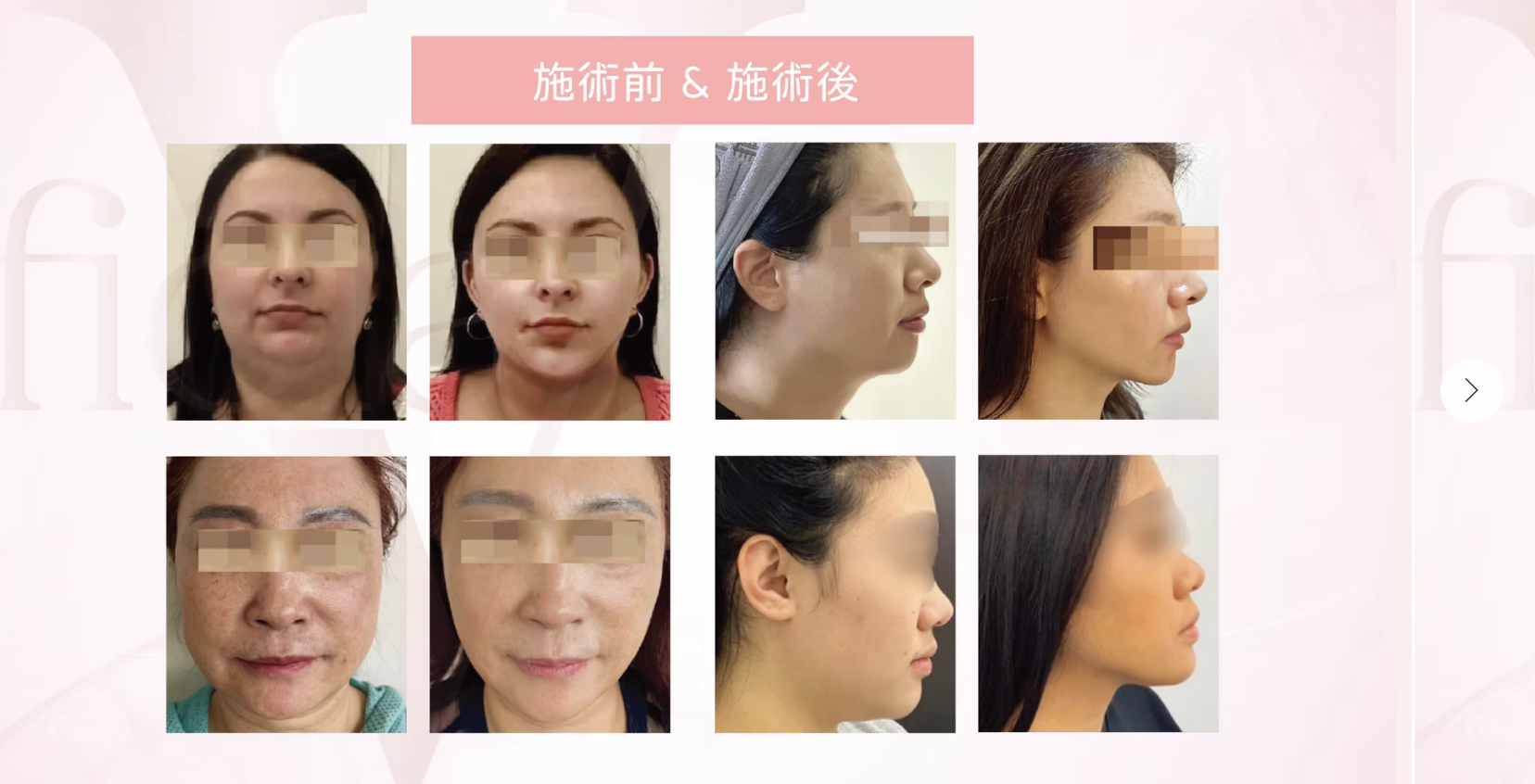 Fiola V小顏溶脂 醫美診所  小颜溶脂 医美诊所