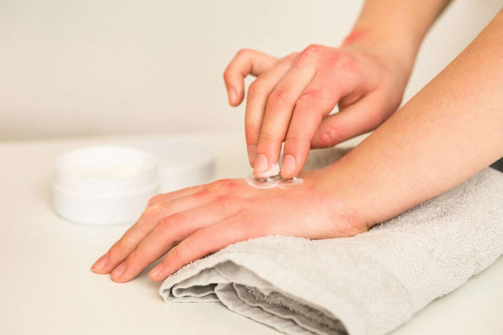 皮膚乾癢＿皮膚乾癢與濕疹的差異