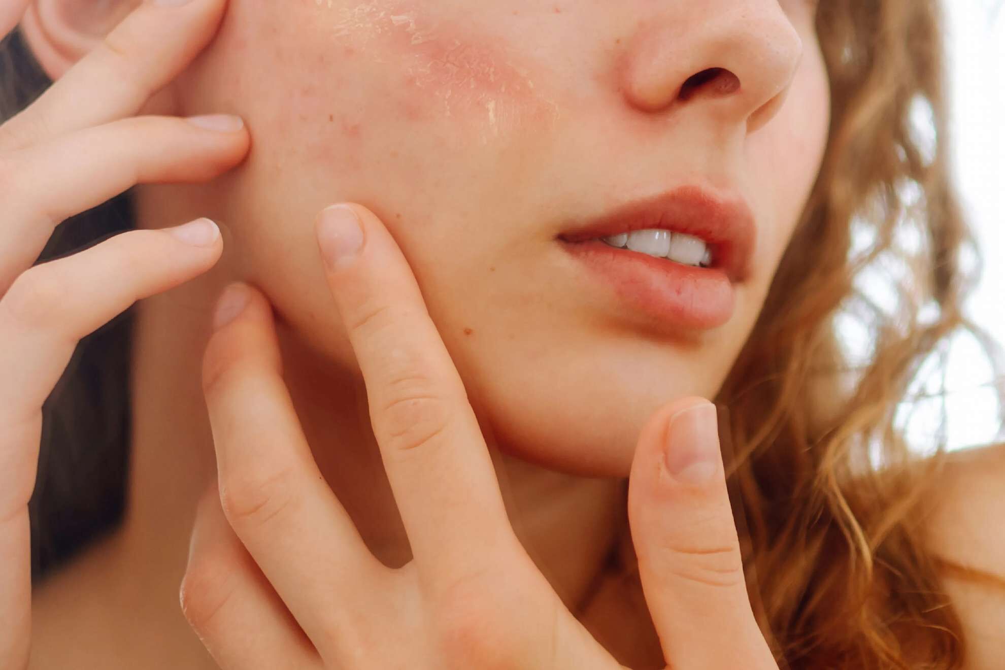 臉脫皮怎麼辦？了解臉乾燥脫皮 6 原因與日常修護的保養步調