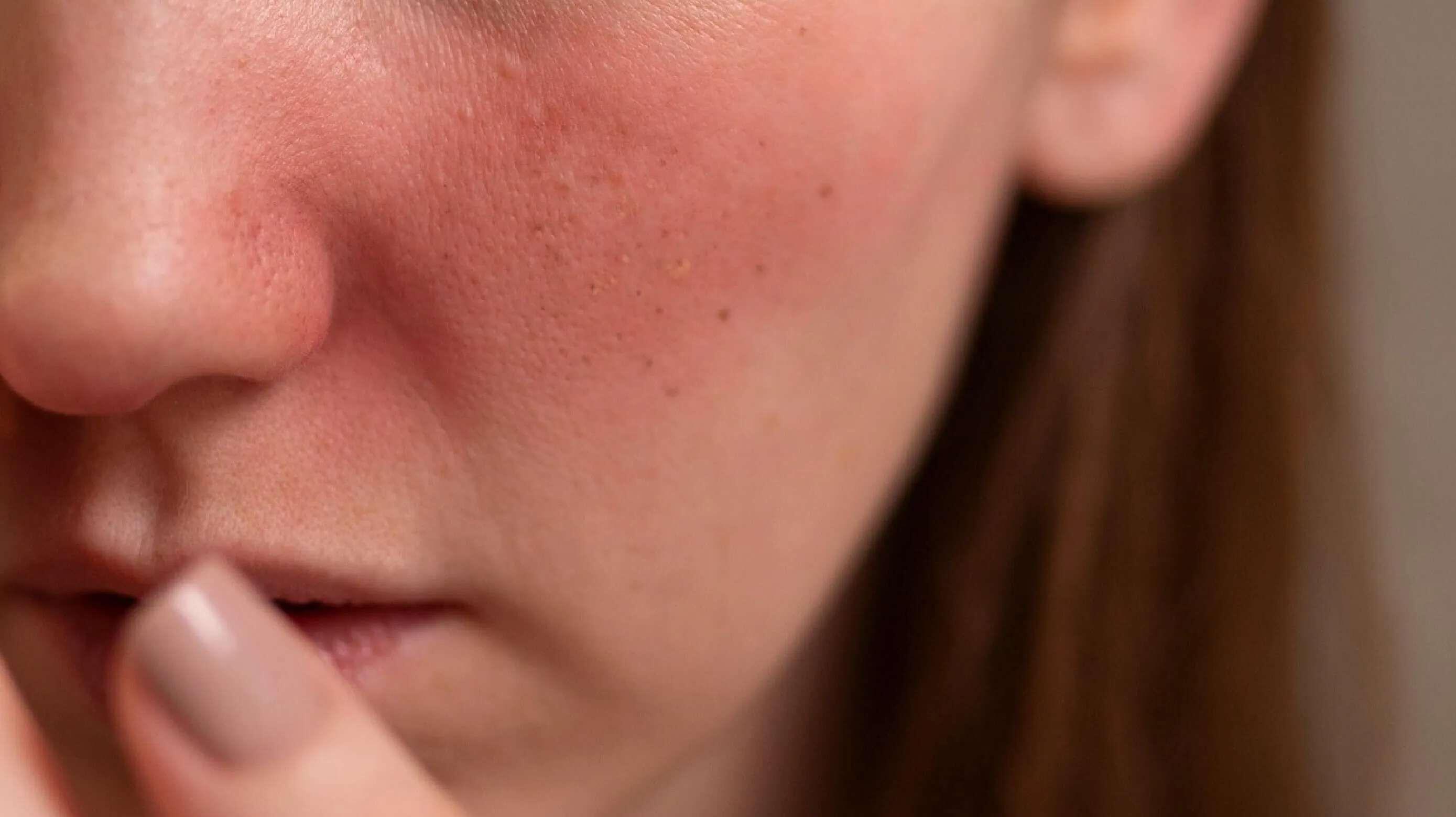 臉頰泛紅怎麼辦？是敏感肌嗎？6 個臉泛紅原因與改善對策