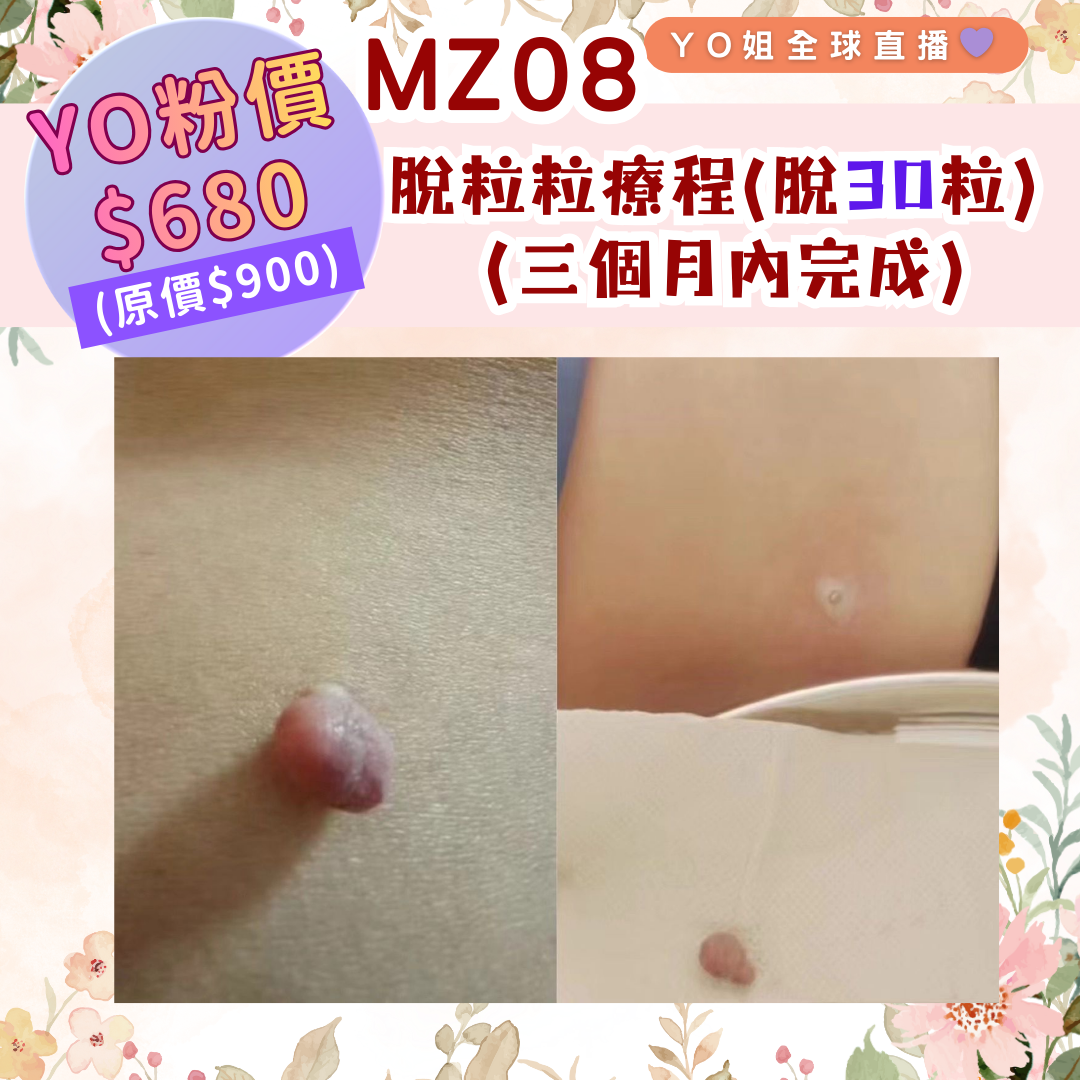 MZ08 脫粒粒療程(脫30粒) (三個月內完成)
