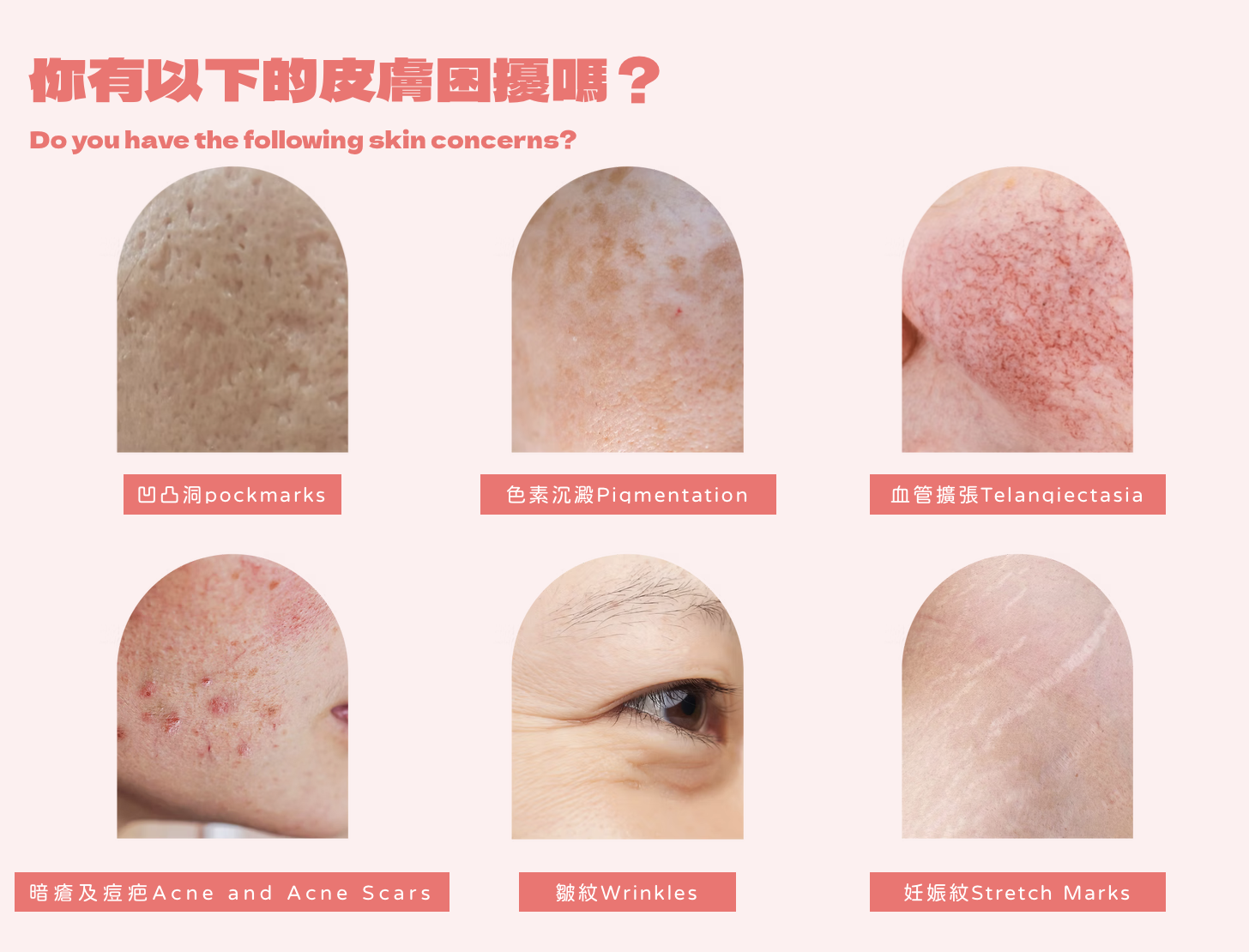 Lumenis M22 ResurFX™ 超點陣激光採用1565nm 專利光纖激光技術,為專有非創傷性分段式激光,透過微小的傷口將激光能量帶入皮膚組織深處,形成所謂的顯微加熱區(MTZ, Microthermal Zone),刺激皮膚組織的膠原蛋白增生、重組,來達到讓肌膚修復、填補凹陷,可強效解決毛孔粗大、凹凸洞、皺紋、妊娠紋、疤痕。