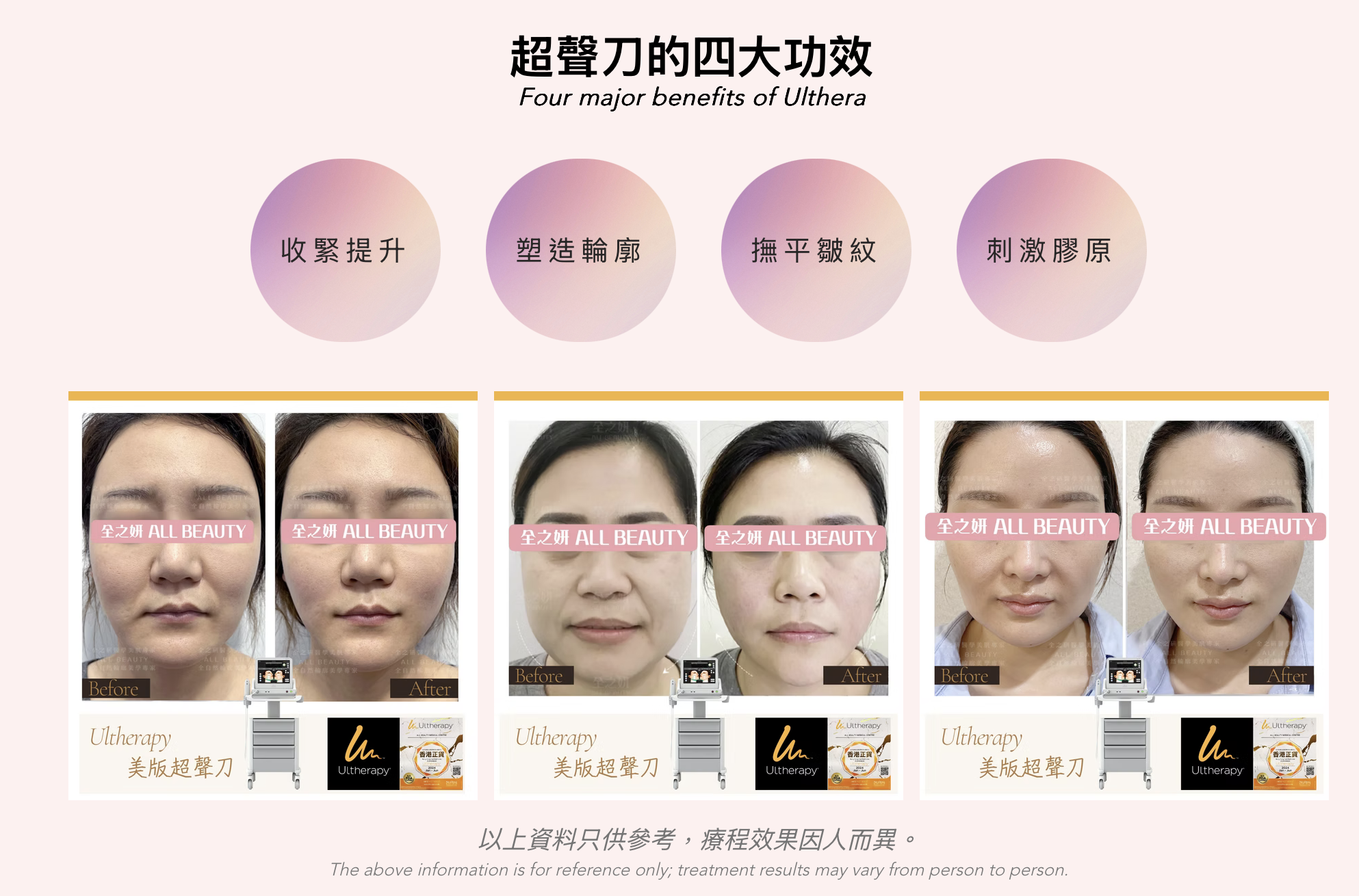 Ultherapy 超聲刀 超声刀