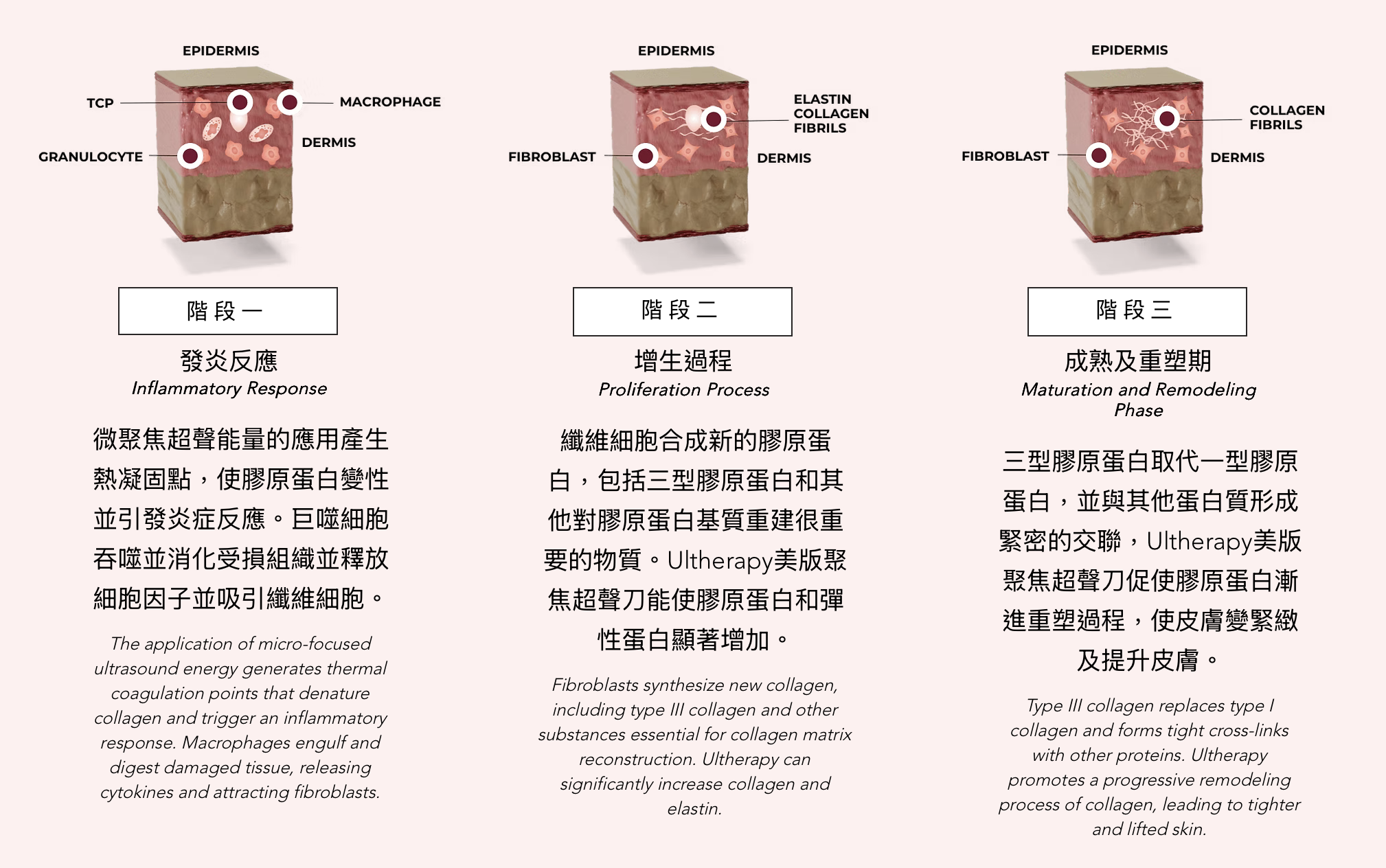 Ultherapy 超聲刀 超声刀