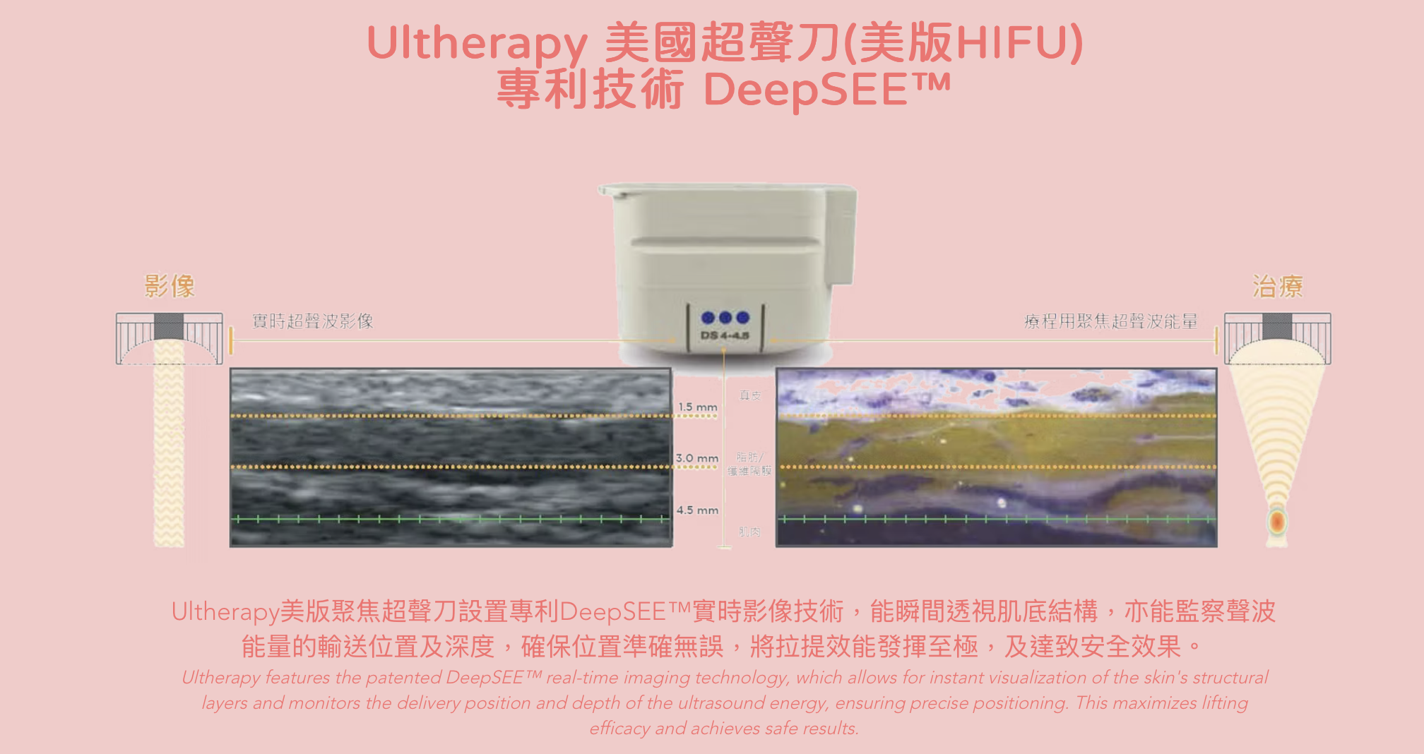 Ultherapy 超聲刀 超声刀