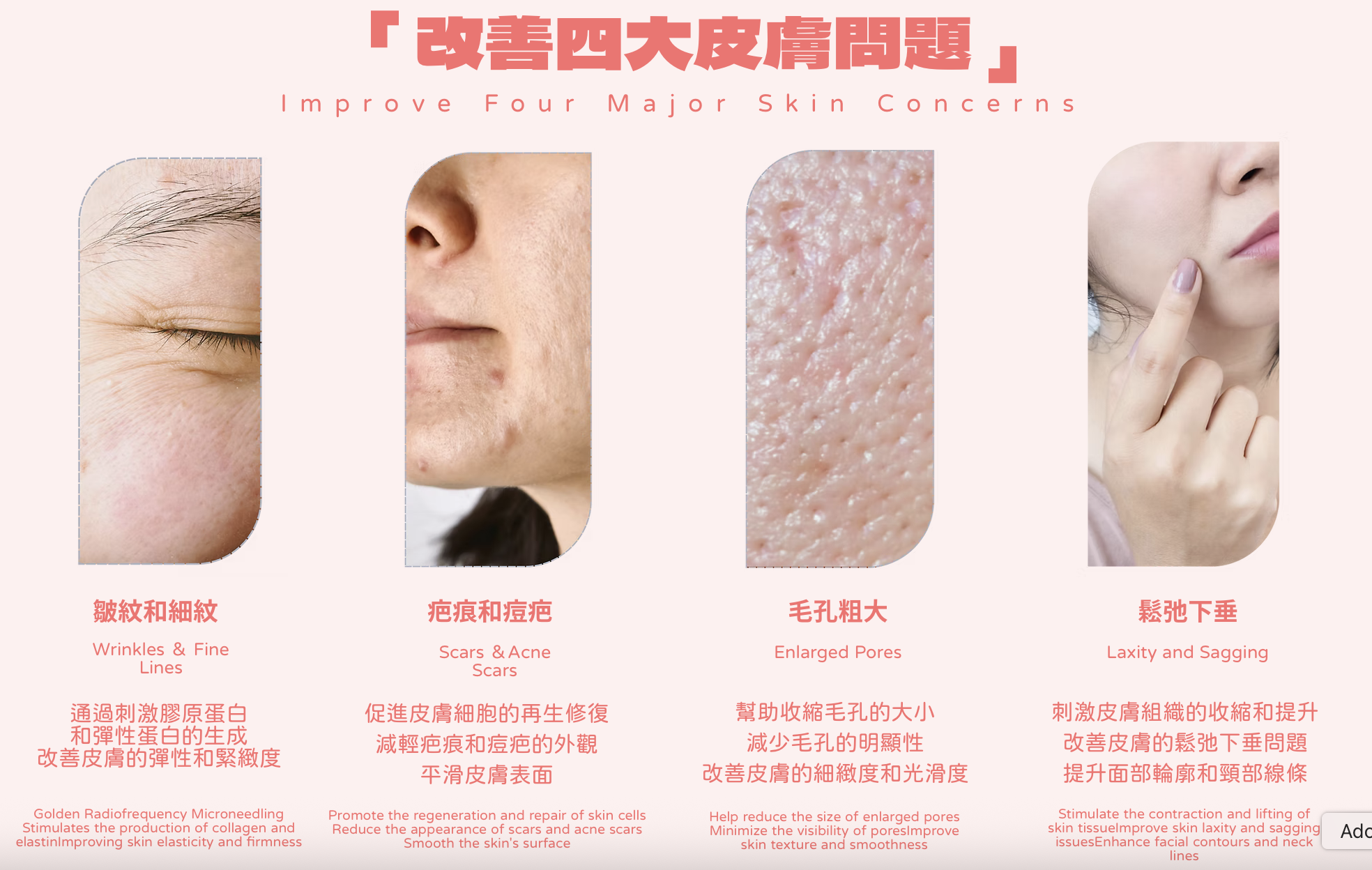 黃金微針 改善粗糙肌、暗瘡印凹凸洞、疤痕、皺紋及老化膚質 黄金微针 改善粗糙肌、暗疮印凹凸洞、疤痕、皱纹及老化肤质