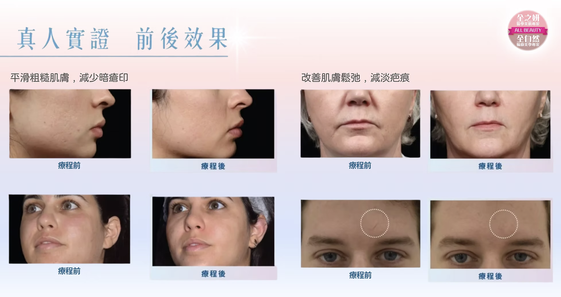 黃金微針 改善粗糙肌、暗瘡印凹凸洞、疤痕、皺紋及老化膚質 黄金微针 改善粗糙肌、暗疮印凹凸洞、疤痕、皱纹及老化肤质