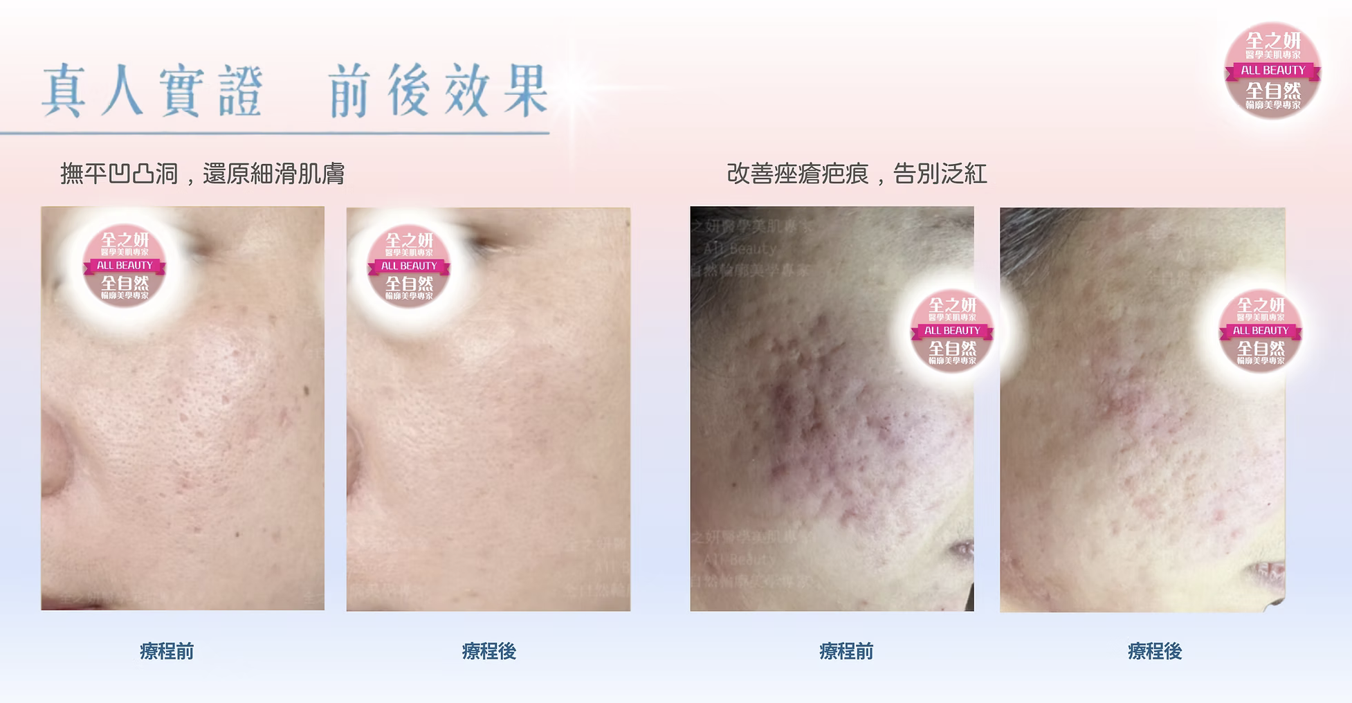 黃金微針 改善粗糙肌、暗瘡印凹凸洞、疤痕、皺紋及老化膚質 黄金微针 改善粗糙肌、暗疮印凹凸洞、疤痕、皱纹及老化肤质