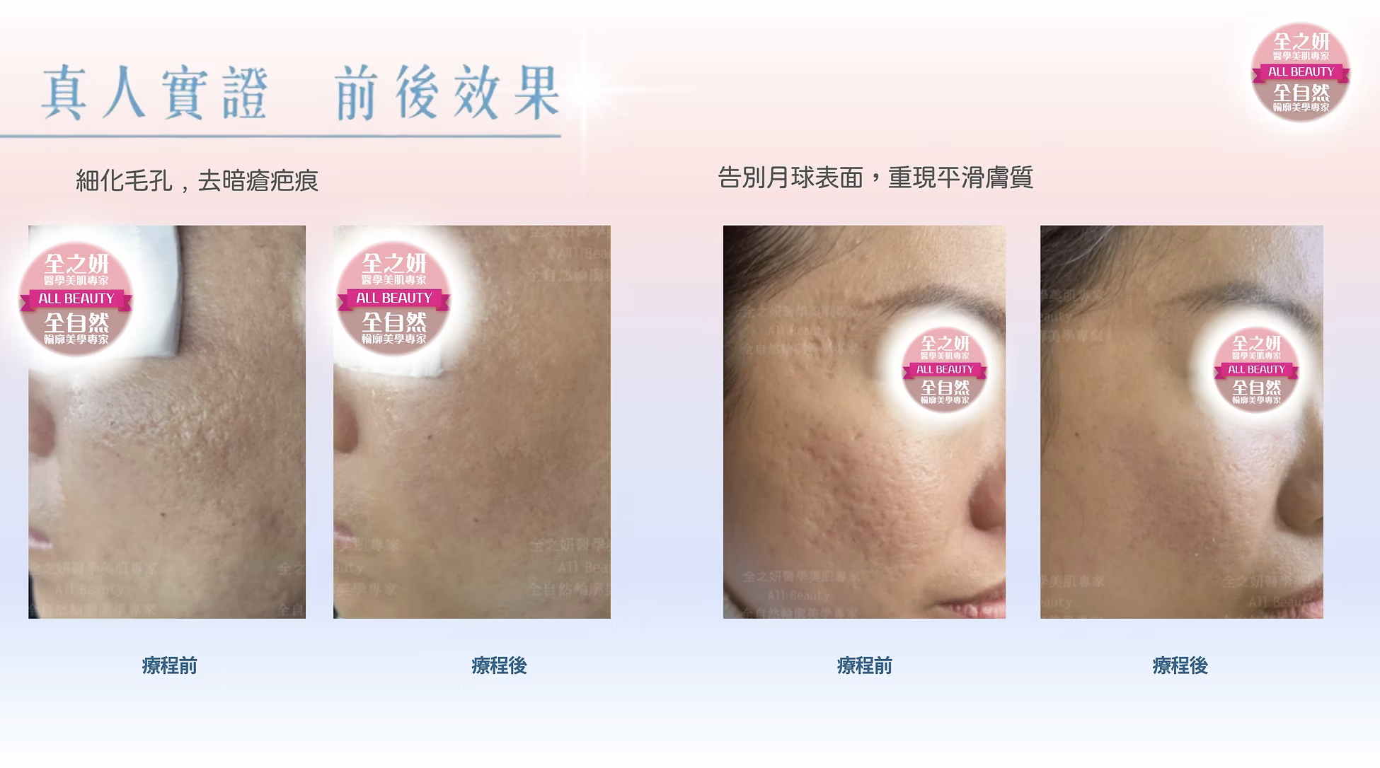 黃金微針 改善粗糙肌、暗瘡印凹凸洞、疤痕、皺紋及老化膚質 黄金微针 改善粗糙肌、暗疮印凹凸洞、疤痕、皱纹及老化肤质