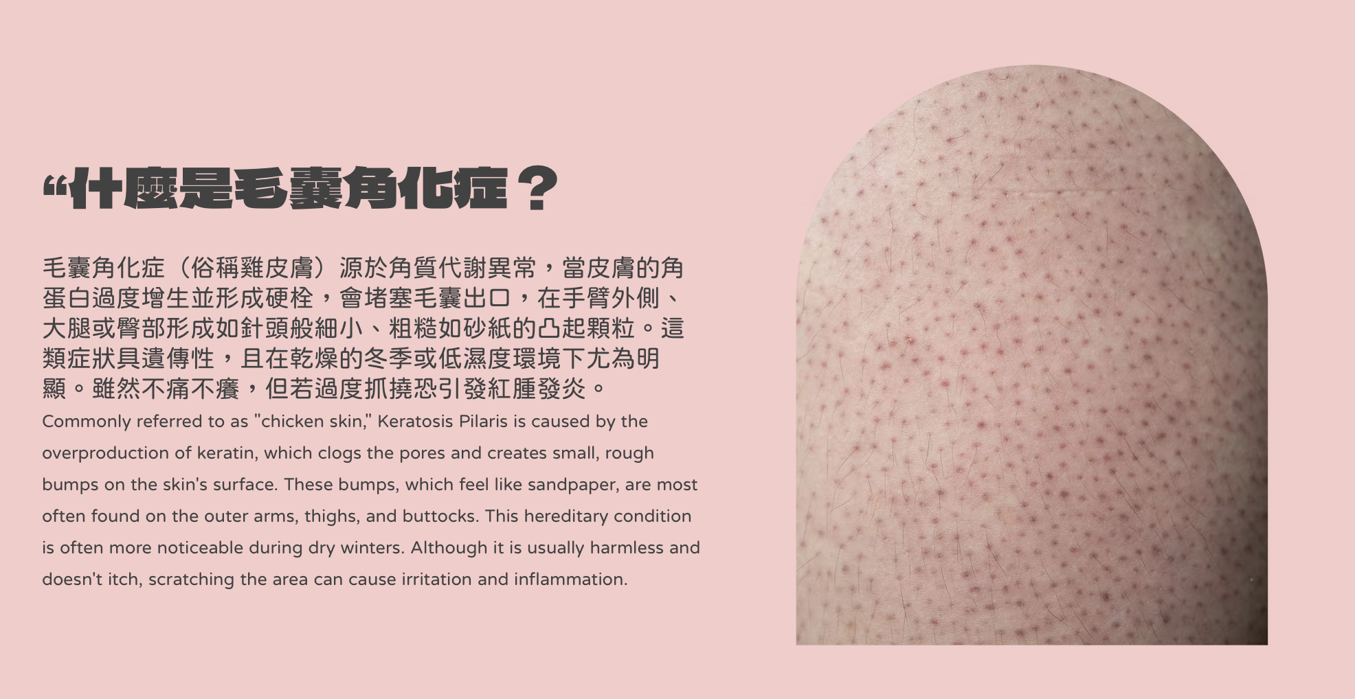 打破傳統單一煥膚限制。我們針對每位客人的膚質與局部問題，量身自由搭配六大醫學級酸類： 醫美界首創的 Lala Peel 溫和煥膚，利用 LHA 專利鹼性技術強化屏障，適合敏感肌即時提亮；針對毛孔與粉刺，選用 Meso 暗瘡酸（水楊酸）深度控油並疏通毛孔。若追求極致平滑，Meso 陶瓷肌能將代謝週期縮短至 5 天，打造零毛孔質感；而針對各類色斑與痘印，則由 Meso 美白酸精準擊碎黑色素。對於局部角質肥厚或頑固瑕疵，結合 Ex 20%/30% 與 甩皮酸，重點處理 T 區、關節或背部粗糙。這種「分區精準施作」的標靶策略，確保高活性成分直達問題根源，實現無痛、高效且全方位的肌膚重生。