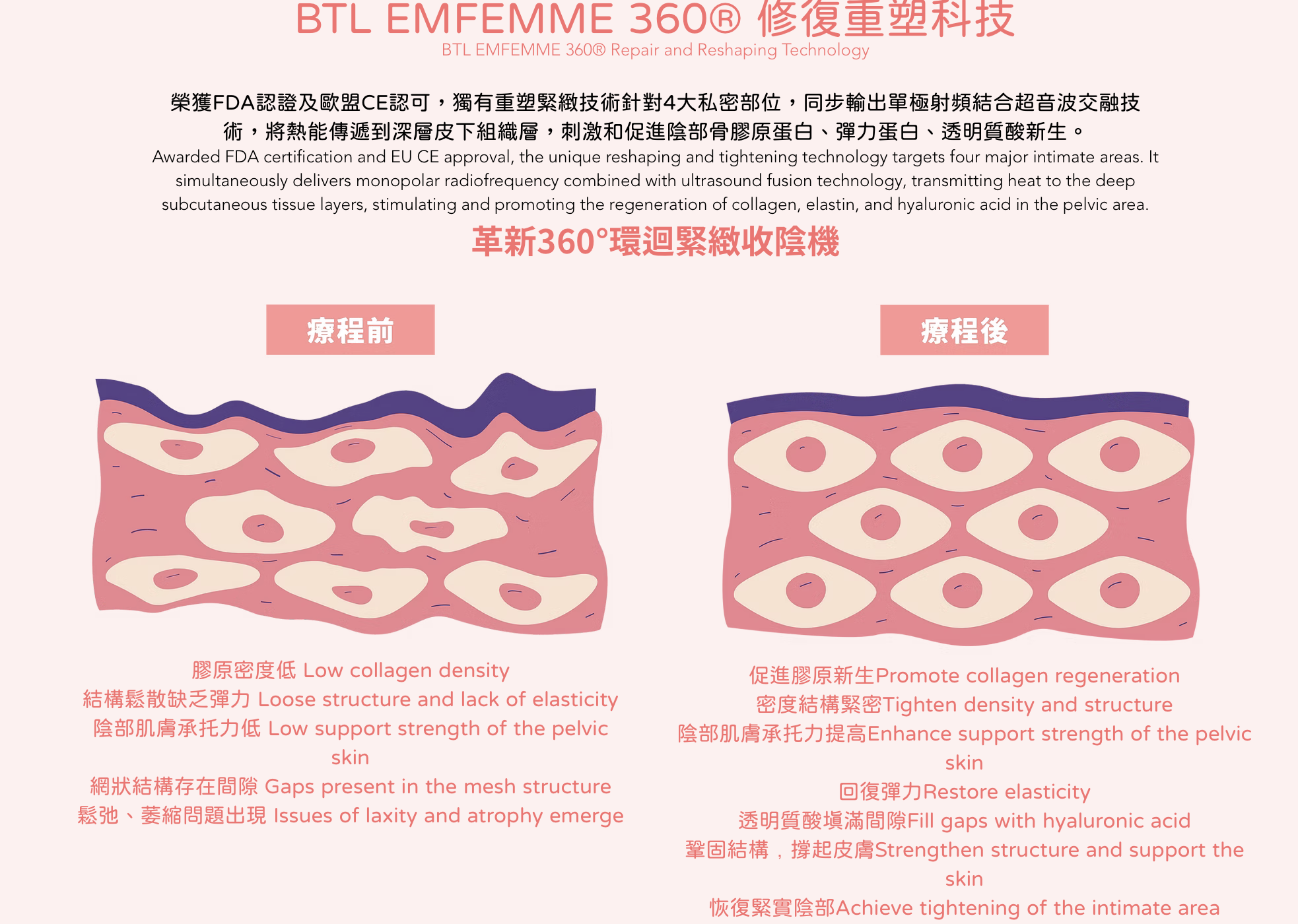 BTL EXION第五代EMFEMME 360私密超頻收陰機，採用AI實時測溫控能系統，實時追縱治療過程中的溫度走向，確保私密部位均勻地360度全面安全地加熱 。​無創無痛快捷，是現時市場上時間最短、最先進、最全面及安全的女性私密治療。