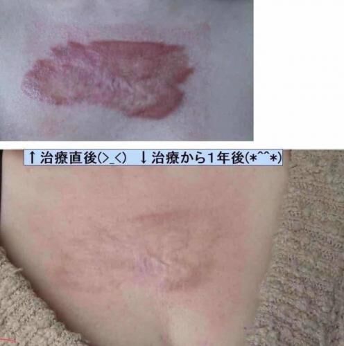 日本HISAMITSU｜小川令（蟹足腫）疤痕貼