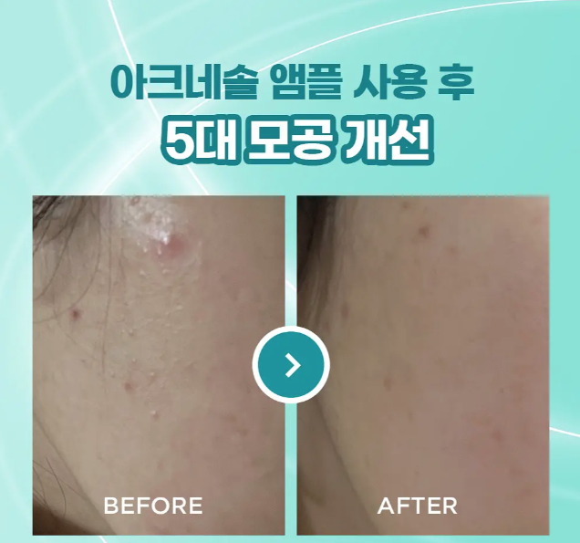 【1+1韓國OY限定組】ATHE Acnesol7日微精安瓶｜藍色款 | 泛紅急救 × 敏感修護 × 舒緩穩定有感