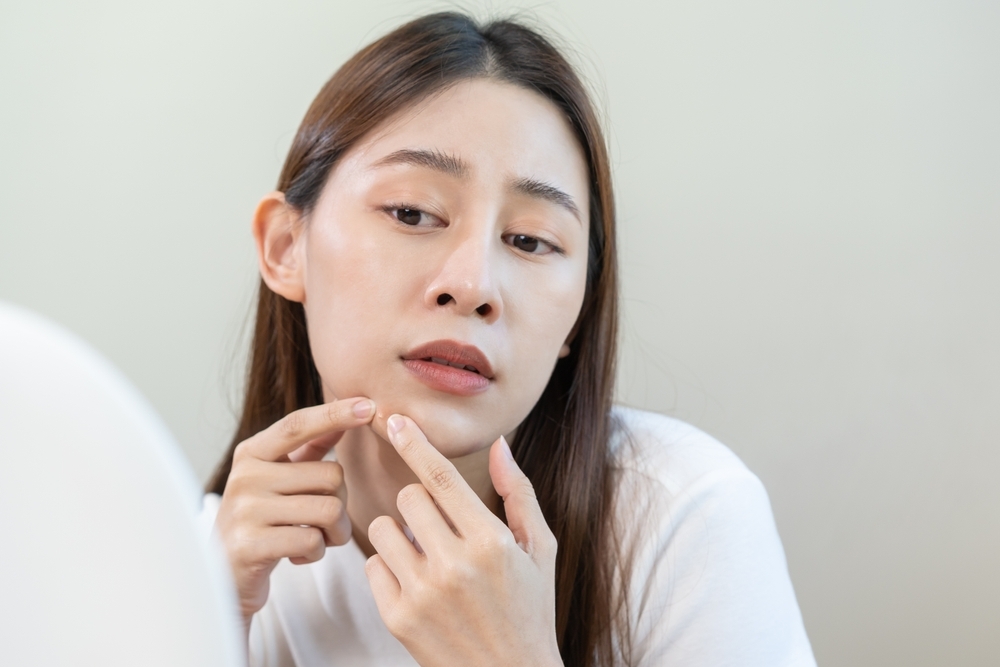 粉刺是什麼？形成原因與處理方式總整理