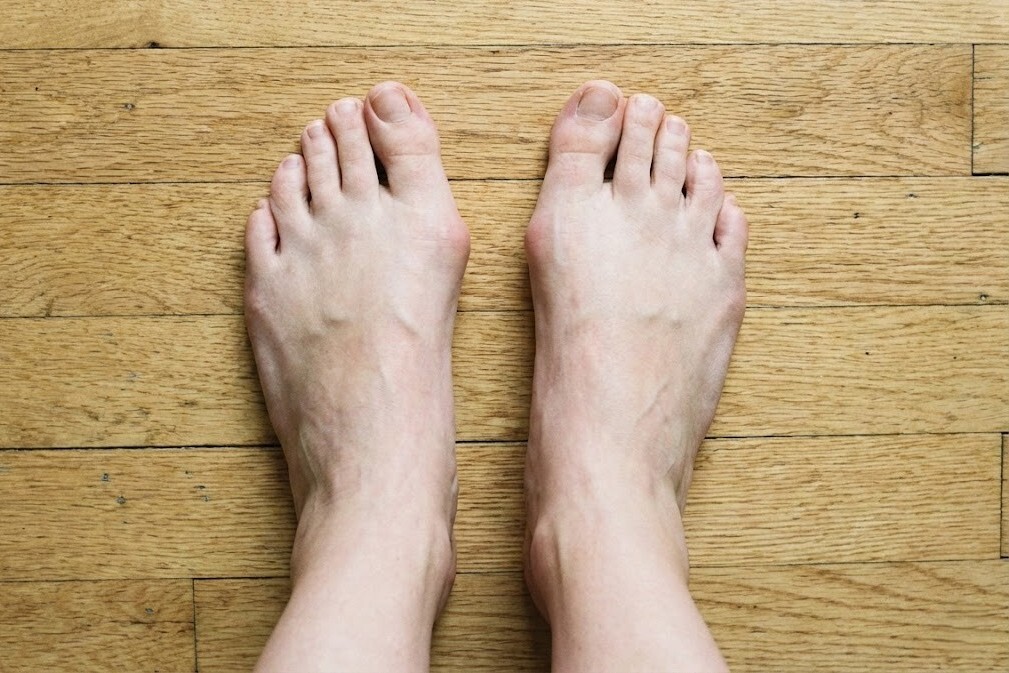 女生寬腳板是意圖，顯示拇指外翻，很難找到好穿的鞋子。