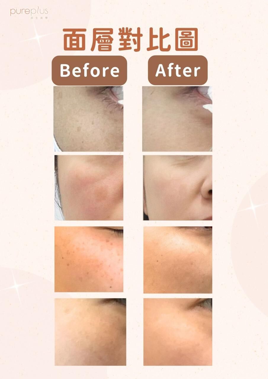 0302PP02-PUPSA- Pureplus 紅血管黑色素專家 針對頑固黑色素紅血管 [只限購買6次] 優惠價 $2888/1次 (A2)