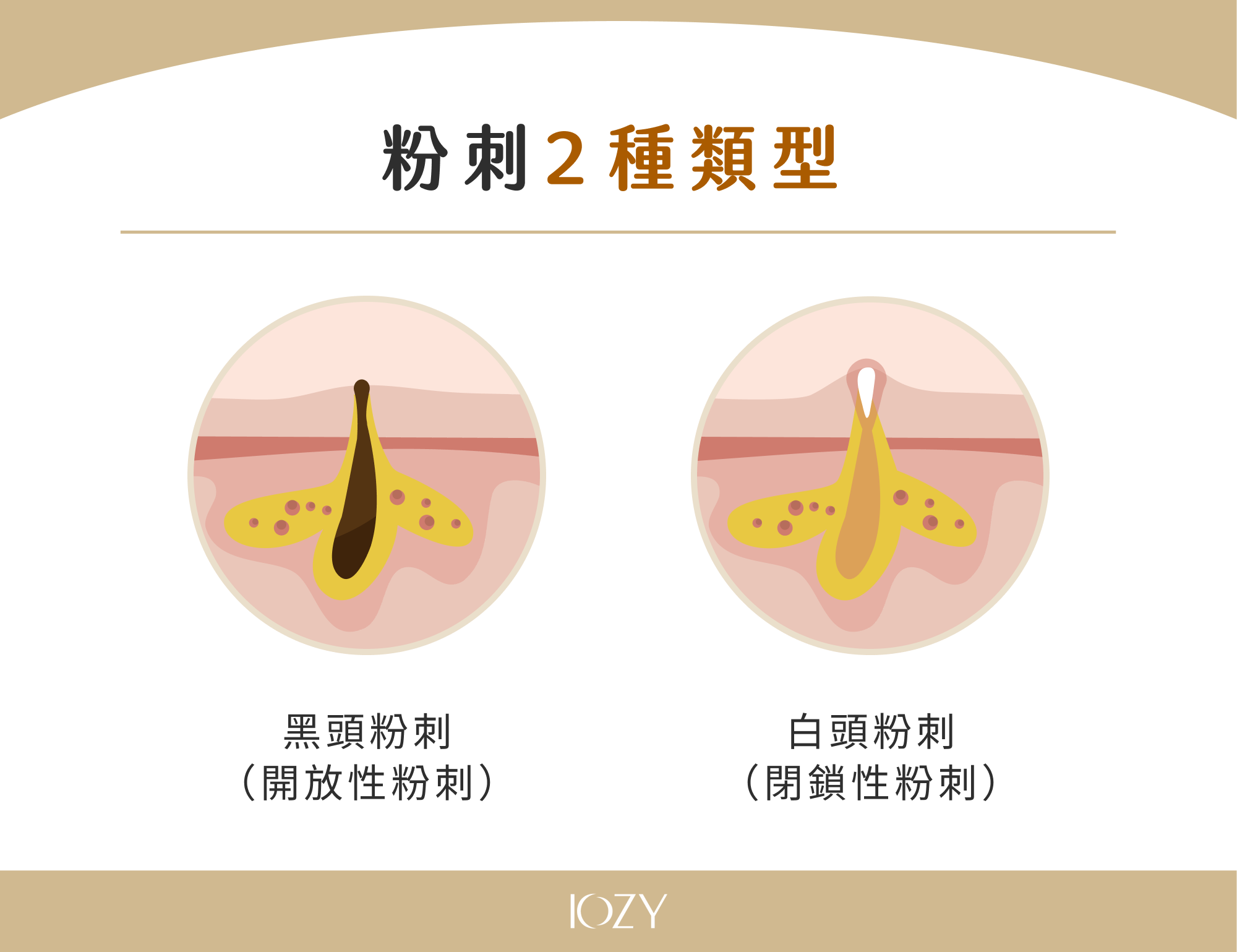 粉刺 2 種類型