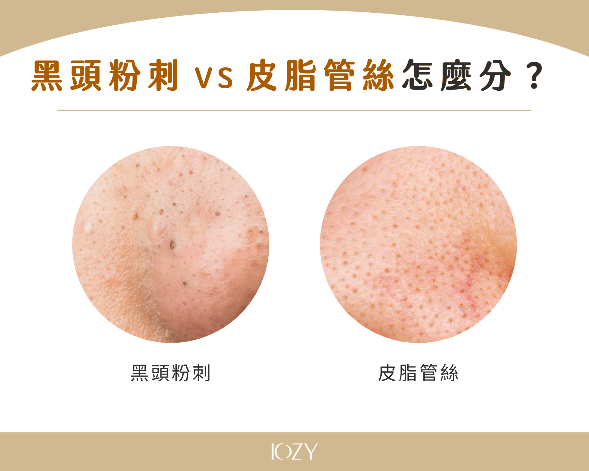 黑頭粉刺 VS 皮脂管絲怎麼分