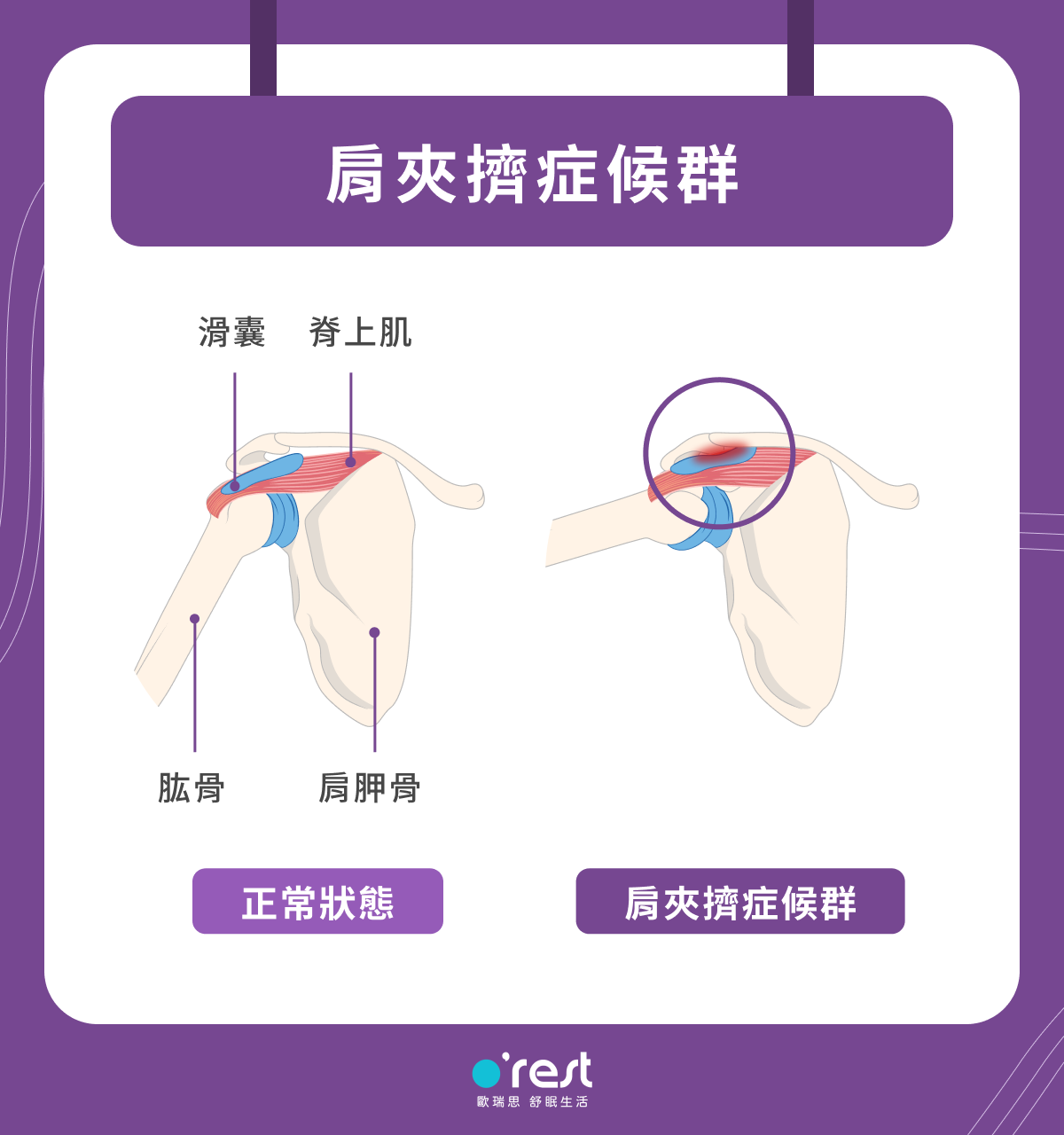 肩夾擠症候群