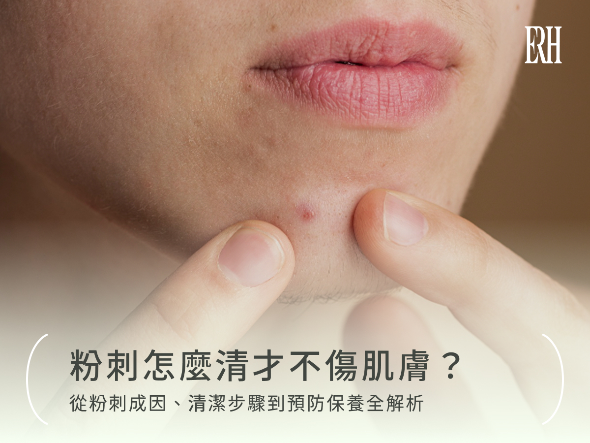 粉刺怎麼清才不傷肌膚?從粉刺成因、清潔步驟到預防保養全解析