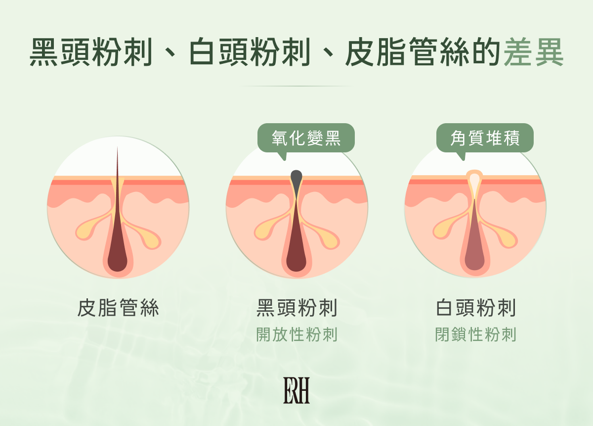 黑頭粉刺、白頭粉刺、皮脂管絲的差異