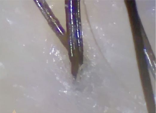 使用後頭皮顯微鏡圖