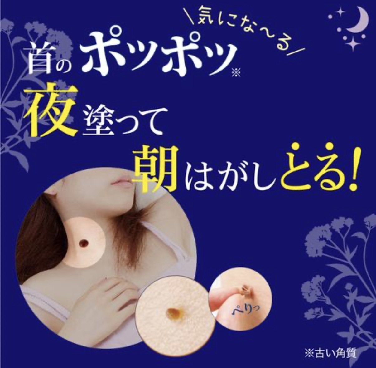 【日本大熱】JP Tsubuporon 夜用去角質粒去疣膏 20g 2307 TK260323