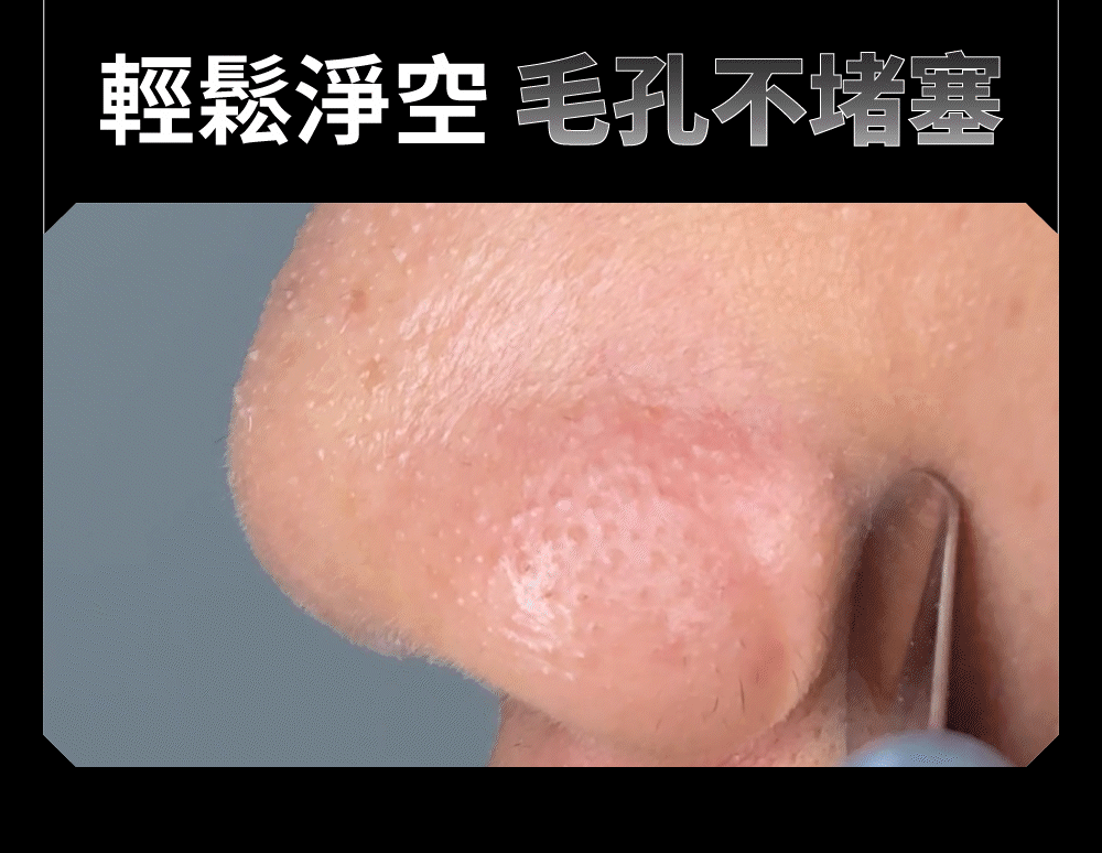 一鏟清除，毛孔不堵塞