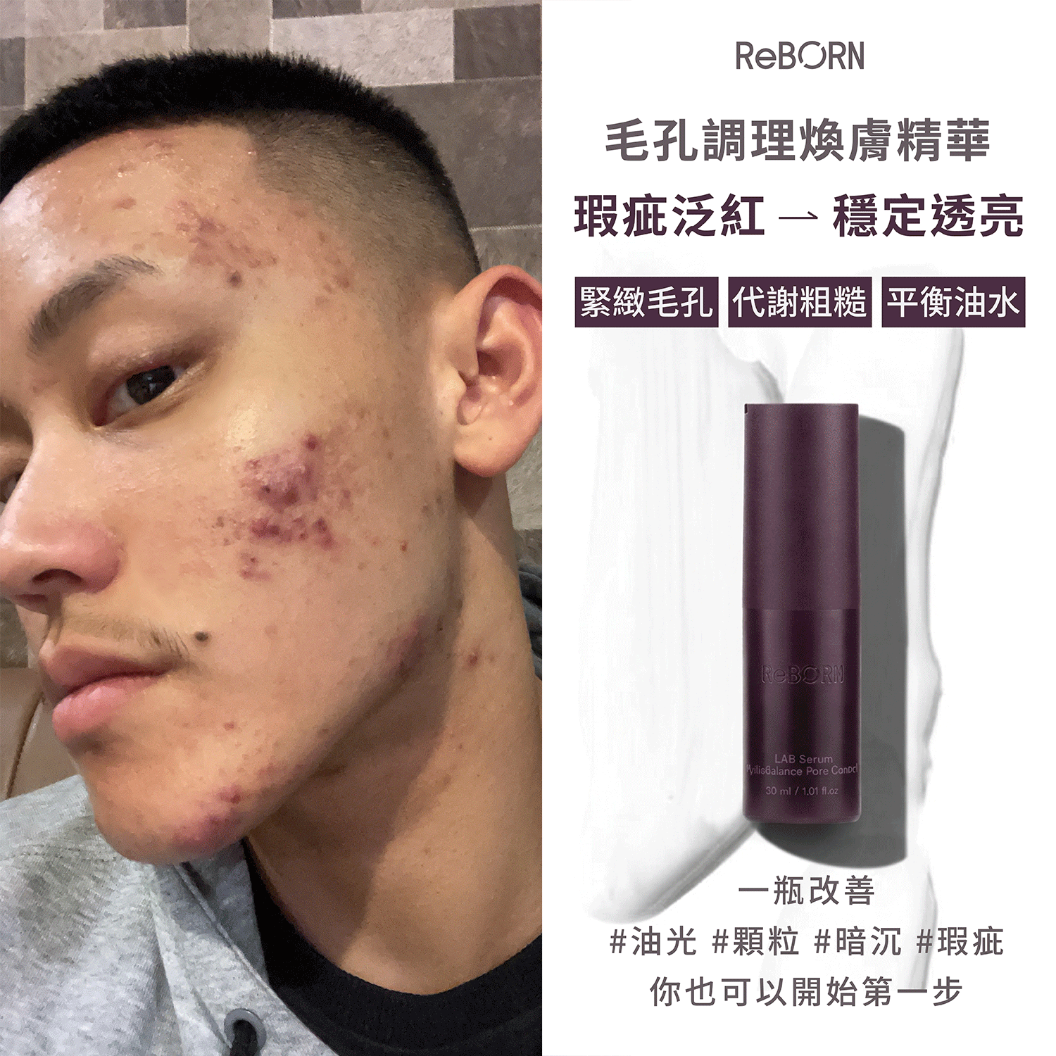 ReBORN 毛孔煥膚精華商品圖，搭配敏感肌使用者臉部痘痘與粗糙膚況變透亮過程