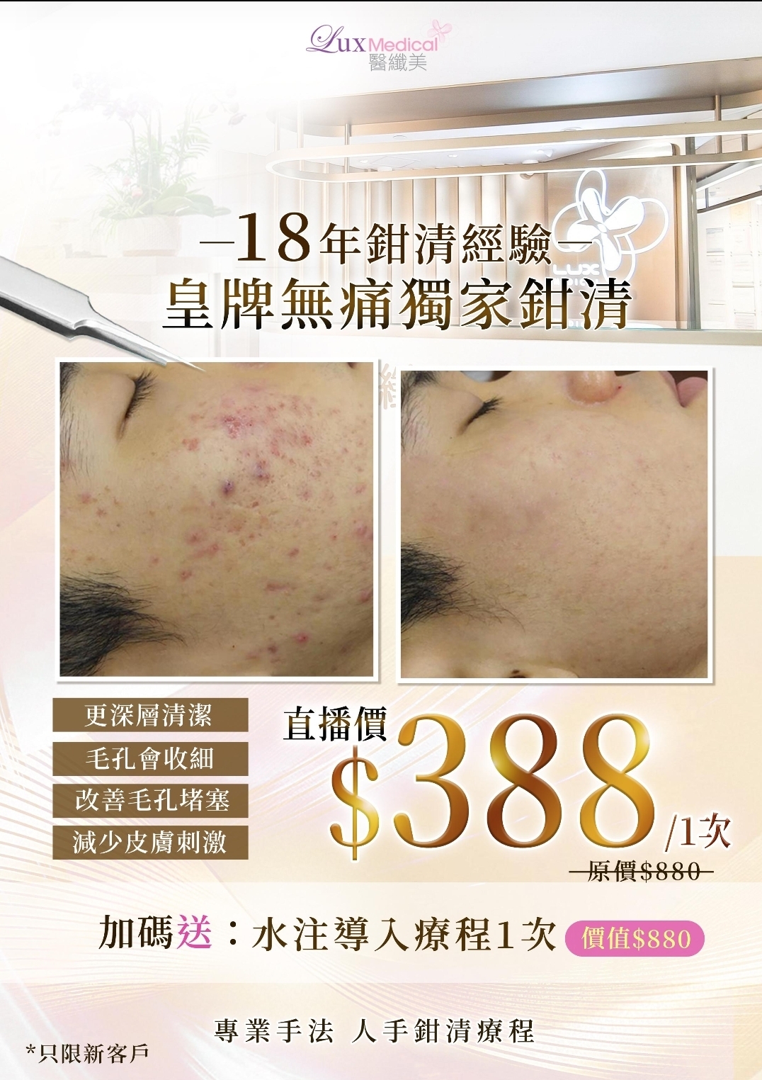 Cf7706  纖美皇牌無痛獨家鉗清‼️$388/ 1次--（原價$880） 再送水注導入（價值$880）  $2800/5次  鉗清$388試做價，只限從來未在本店體驗過鉗清服務的顧客，就可以惠顧一張🔆 🔆$2800/5次療程新舊客戶均可購買，最多購買兩套🔆
