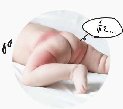 寶寶大腿勒出的紅印