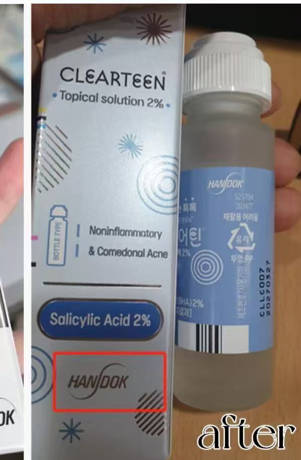 CF7901韓國藥房熱賣 HANDOK Acne Clearteen 水楊酸祛痘抗粉刺抗痘水 – 30ml  $99/1 $195/2