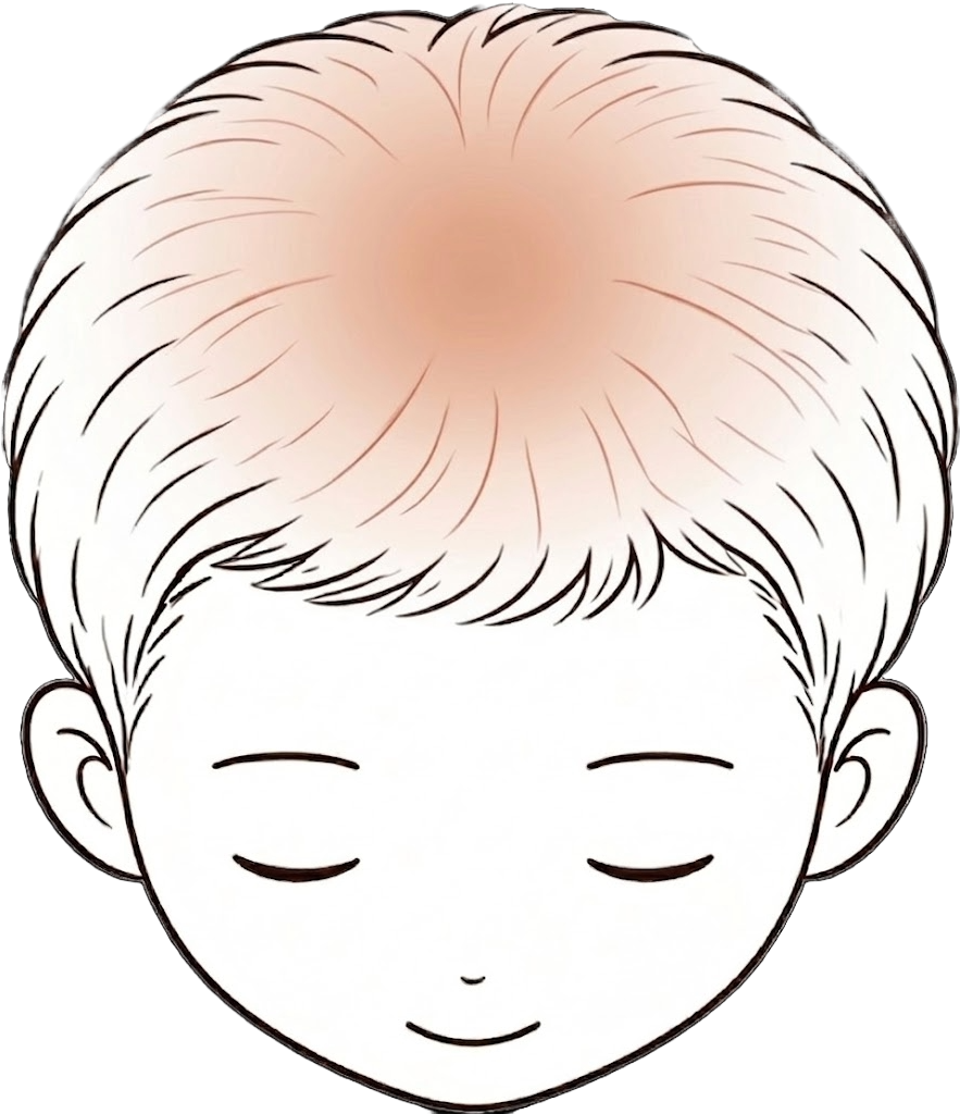 頭頂 / 髮旋稀疏